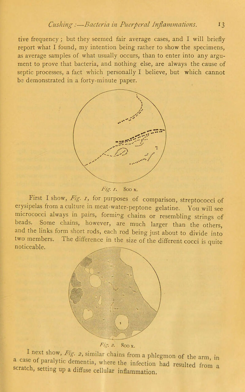 tive frequency; but they seemed fair average cases, and I will briefly report what I found, my intention being rather to show the specimens, as average samples of what usually occurs, than to enter into any argu- ment to prove that bacteria, and nothing else, are always the cause of septic processes, a fact which personally I believe, but which cannot be demonstrated in a forty-minute paper. I. 800 X. First I show. Fig. i, for purposes of comparison, streptococci of erysipelas from a culture in meat-water-peptone gelatine. You will see micrococci always in pairs, formi*^g chains or resembling strings of beads. Some chains, however, are much larger than the others, and the links form short rods, each rod being just about to divide into two members. The difference in the size of the different cocci is quite noticeable. Fig- 3- 800 X. I next show. Fig. 2, similar chains from a phlegmon of the arm in a case of paralytic dementia, where the infection had resulted from a scratch, setting up a diffuse cellular inflammation.