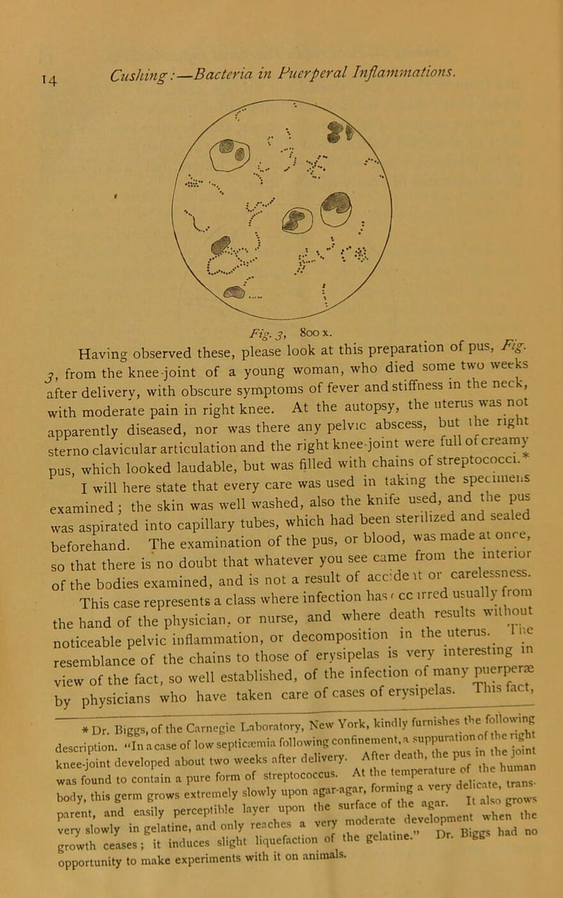 Fig. 3, 800 X. Having observed these, please look at this preparation of pus, Fif^- j, from the knee-joint of a young woman, who died some two weeks after delivery, with obscure symptoms of fever and stiffness m the neck, with moderate pain in right knee. At the autopsy, the uterus was not apparently diseased, nor was there any pelvic abscess, but ihe right sterno clavicular articulation and the right knee-joint were full of creamy pus, which looked laudable, but was filled with chains of streptococci. I will here state that every care was used in taking the specimens examined; the skin was well washed, also the knife used, and the pus was aspirated into capillary tubes, which had been sterilized and sealed beforehand. The examination of the pus, or blood, was made at once, so that there is no doubt that whatever you see came from the interior of the bodies examined, and is not a result of acc’.deit or carelessness. This case represents a class where infection has ^ cc irred usually from the hand of the physician, or nurse, and where death results without noticeable pelvic inflammation, or decomposition m the uterus, n.e resemblance of the chains to those of erysipelas is very interesting in view of the fact, so well established, of the infection of many Fierper^ by physicians who have taken care of cases of erysipelas. This fact, *Dr. B.ggs, of the Carnegie Laboratory. New York. kindi;7urnishes the fol^^ description. -L a case of low septicxmia following confinement, a suppuration of he ng SI. developed «bo„. two «=eks delivery. Abe, dee.b, ,he per rn he ,o,n w„ ind .0 eoniein a pure form of Mreploeoecor. A, the body, .his germ grows es.re.n.ly slowly upon eg.r-»g.sr, fonorng a very de eme .r parea. ..P-tlVShT: rry'mlde'rat d'e.Xmea. whe' ,he S S o? ,he gela.i„e,.. Hr. Biggs had 00 opportunity to make experiments with it on animals.