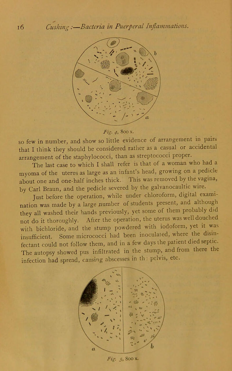 so few in number, and show so little evidence of arrangement in pairs that I think they should be considered rather as a casual or accidental arrangement of the staphylococci, than as streptococci proper. The last case to which I shall refer is that of a woman who had a myoma of the uterus as large as an infant’s head, growing on a pedicle about one and one-half inches thick. This was removed by the vagina, by Carl Braun, and the pedicle severed by the galvanocaultic wire. Just before the operation, while under chloroform, digital exami- nation was made by a large number of students present, and although they all washed their hands previously, yet some of them probably did not do it thoroughly. After the operation, the uterus was well douched with bichloride, and the stump powdered with iodoform, yet it was insufficient. Some micrococci had been inoculated, where the disin- fectant could not follow them, and in a few days the patient died septic. The autopsy showed pus infiltrated in the stump, and from there the infection had spread, causing abscesses in th: pelvis, etc. Fig. s, 800 X.