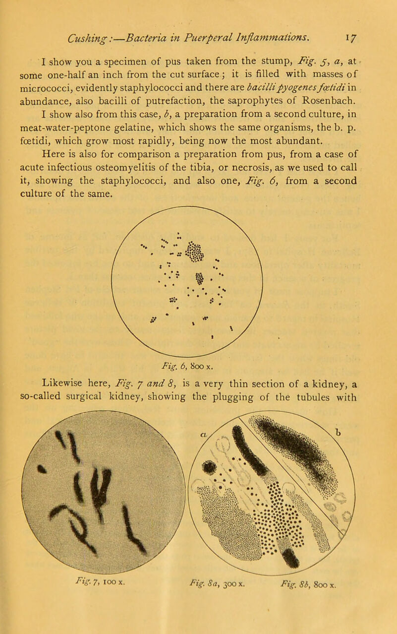 I show you a specimen of pus taken from the stump, Fig. 5, a, at - some one-half an inch from the cut surface; it is filled with masses of micrococci, evidently staphylococci and there are bacilli pyogenes fatidi in abundance, also bacilli of putrefaction, the saprophytes of Rosenbach. I show also from this case, b, a preparation from a second culture, in meat-water-peptone gelatine, which shows the same organisms, the b. p. fcetidi, which grow most rapidly, being now the most abundant. Here is also for comparison a preparation from pus, from a case of acute infectious osteomyelitis of the tibia, or necrosis, as we used to call it, showing the staphylococci, and also one, Fig. 6, from a second culture of the same. Likewise here. Fig. 7 and 8, is a very thin section of a kidney, a so-called surgical kidney, showing the plugging of the tubules with r