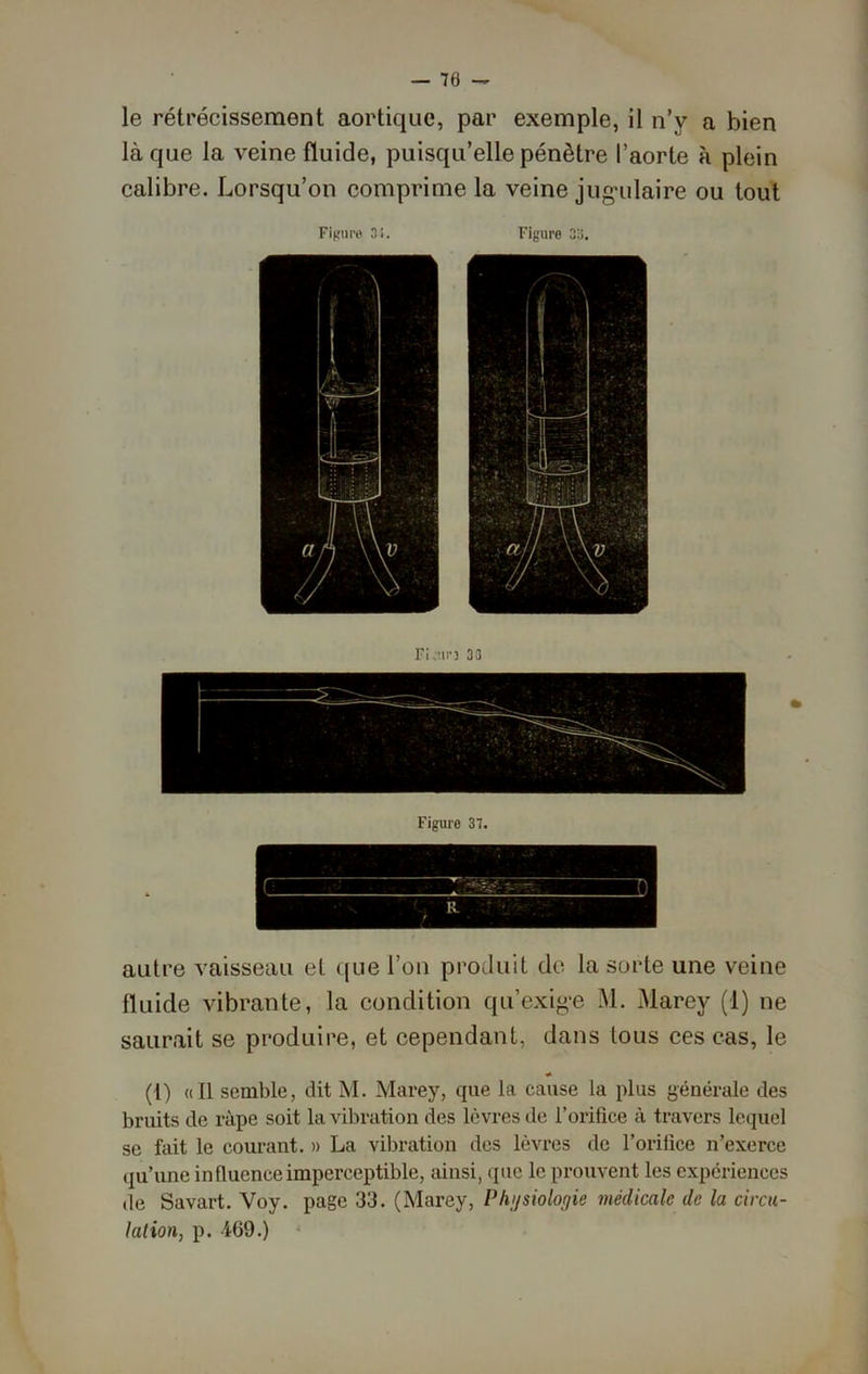 — 70 - le rétrécissement aortique, par exemple, il n’y a bien laque la veine fluide, puisqu’elle pénètre l’aorte à plein calibre. Lorsqu’on comprime la veine jugulaire ou tout Figure 31. Figure 3b. Fi,un 33 Figure 37. R autre vaisseau et que l’on produit de la sorte une veine fluide vibrante, la condition qu’exige M. Marey (1) ne saurait se produire, et cependant, dans tous ces cas, le * (1) «Il semble, dit M. Marey, que la cause la plus générale des bruits de râpe soit la vibration des lèvres de l’orifice à travers lequel se fait le courant. » La vibration des lèvres de l’orifice n’exerce qu’une in fluence imperceptible, ainsi, que le prouvent les expériences de Savart. Voy. page 33. (Marey, Physiologie médicale de la circu- lation, p. 469.)