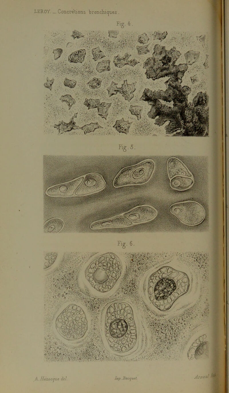 LEROY. _ Concrétions bronchiques . /I. Henoctpic dcl. lmp Jiecquct. Arn oui