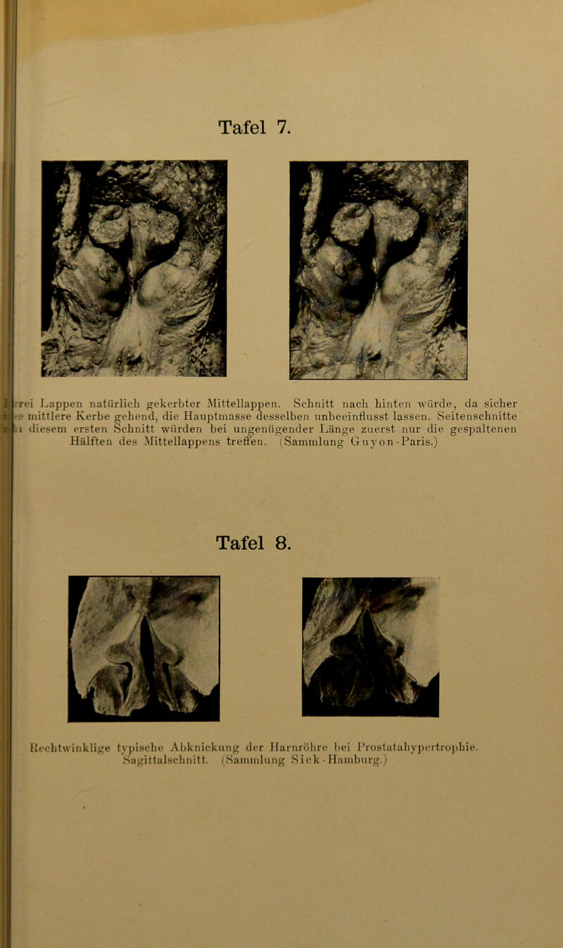 rei Lappen natürlich gekerbter Mittellappen. Schnitt nach hinten würde, da sicher ■e mittlere Kerbe gehend, die Hauptmasse desselben unbeeinflusst lassen. Seitenschnitte 1 diesem ersten Schnitt würden bei ungenügender Länge zuerst nur die gespaltenen Hälften des Mittellappens treffen. (Sammlung Guyon-Paris.) Tafel 8. Rechtwinklige typische Abknickung der Harnrölire bei Prostalahypertrophie. Sagittalschnitt. (Sammlung S ick - Hamburg.)