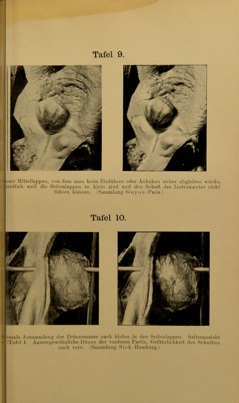 ■; -ser Mittellappen, von dem man beim Einfuhren oder Anhaken sicher abgleiten würde, ! ■'3ntlich weil die Seitenlappen so klein sind und den Schaft des Instrumentes nicht führen können. ^Sammlung Guyon-Paris.) Tafel 10. I ssale Ansammlung der Drüsenmasse nach hinten in den Seitonla])pen. Seitenansicht T Tafel 1. Ajissergewöhnliche Dünne der vorderen Partie, Gefiilirlielikeit des Schnittes nach vorn. (Sammlung S i c l< - Hamburg.) I 1