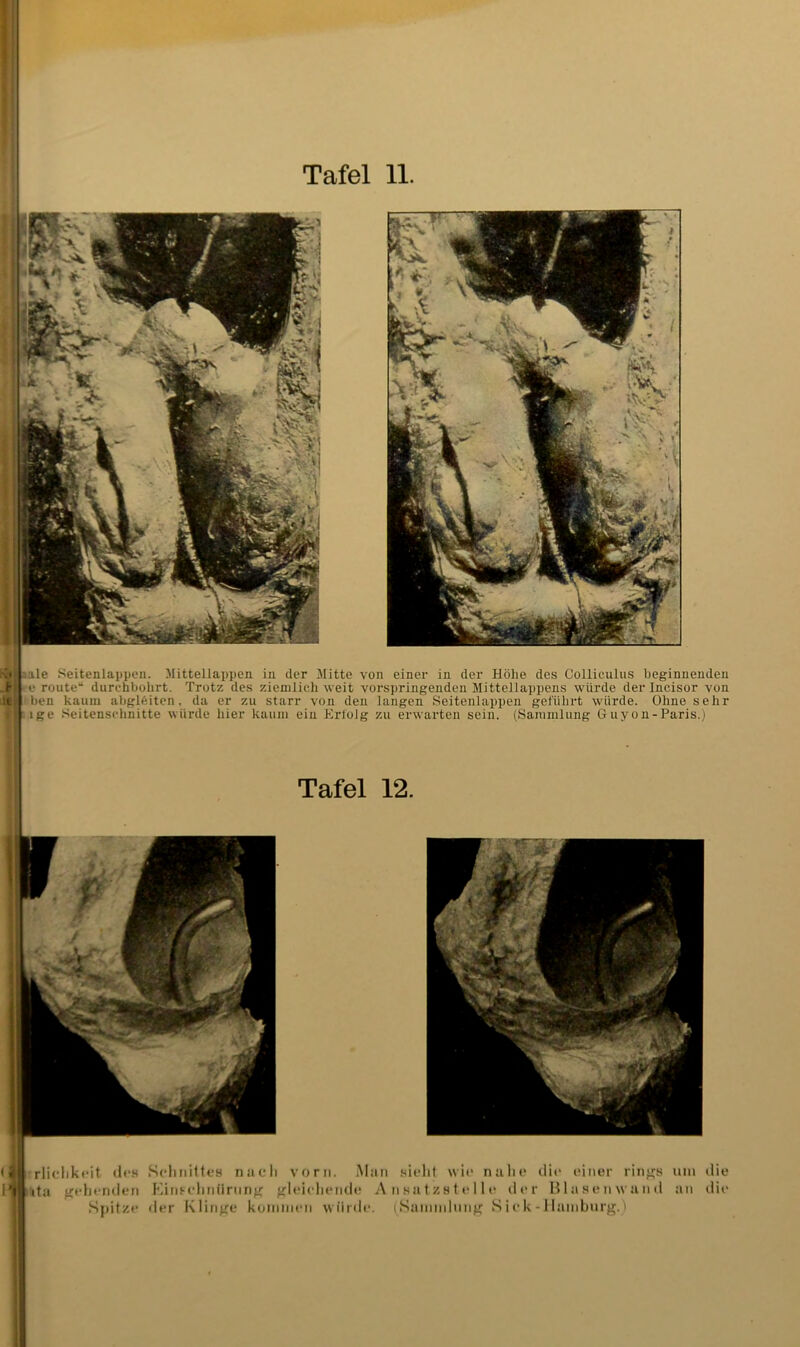 uale Seitenlappcn. Mittellappen in der Mitte von einer in der Höhe des Colliculus beginnenden •e route“ durchbohrt. Trotz des ziemlich weit vorspringenden Mittellappens würde der Incisor von ;ben kaum abgl6itcn, da er zu starr von den langen Seitenlappen geführt würde. Ohne sehr , ige Seitenschnitte würde hier kaum ein Erfolg zu erwarten sein. (Sammlung Guyon-Paris.) ‘ rliclikeit des ita frelHrideri Spitze Sehniltfs naeli vorn. Man sielit wie nahe die einer rinjj;8 Kiiii-ehniirtin^ jileieliende A n h a t z 81 e 11 e der Blasenwand der Klinj^e koiniiien würde. (Saniinlnng S i e k -1 lamburg.' um die an liie