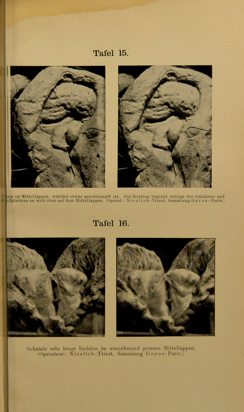 /On im Mittellappen, welcher etwas geschrumpft ist. Die Incision beginnt infolge des Anhakens und . fgleitens zu weit oben auf dem Mittellappen. (Operat.: Nico 1 ich-Triest, Sammlung Guy on-Paris.) Tafel 16. I 1 Sehiilalf sehr Incision ini ausnehmend grossen .Mittellapj)en. Mlperateur: N i co l i c h-'I'riest, .Saininlung (! ii y o n - Paris.)