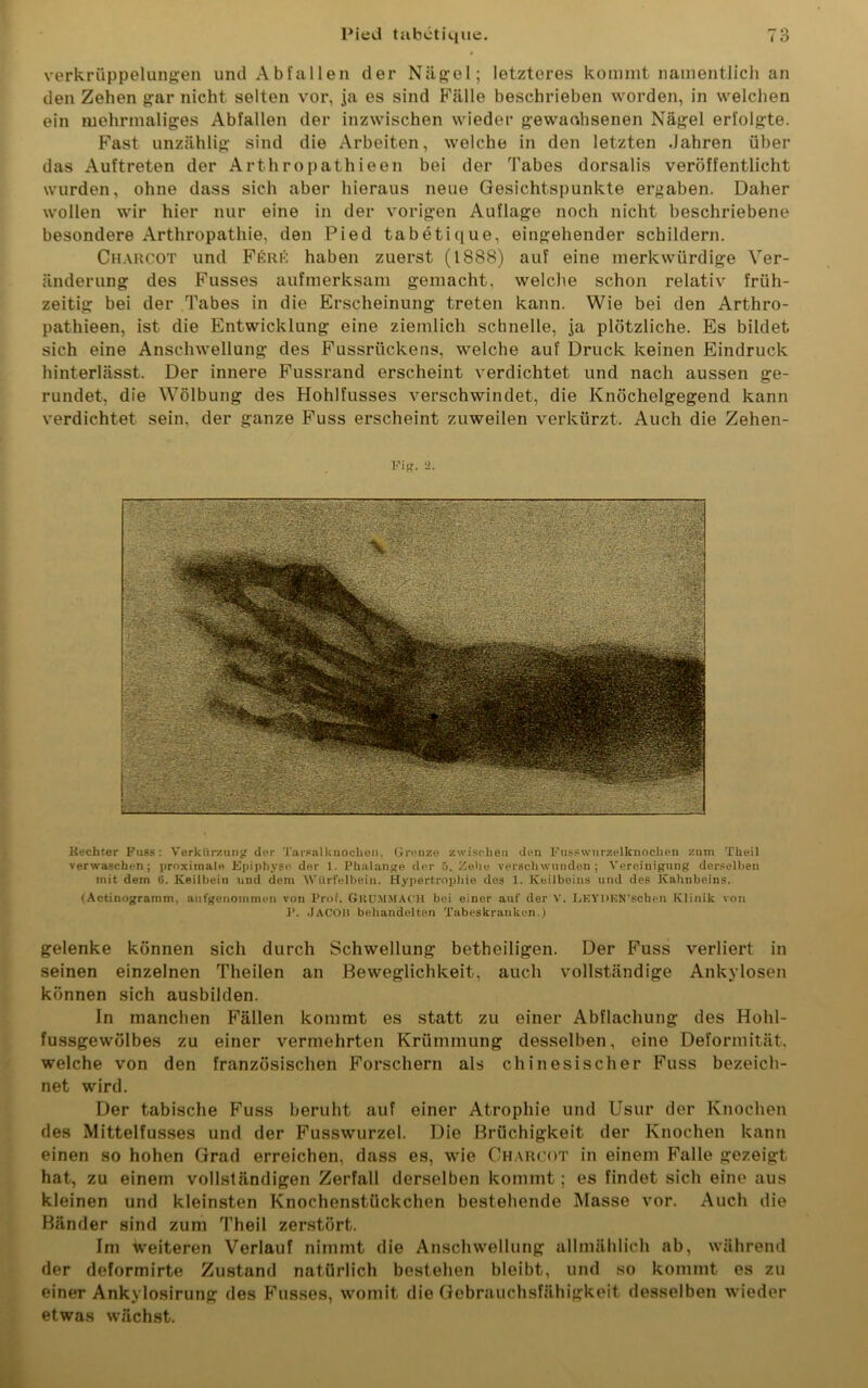 Pied tabetique. Verkrüppelungen und Abfallen der Nägel; letzteres kommt namentlich an den Zehen gar nicht selten vor, ja es sind Fälle beschrieben worden, in welchen ein mehrmaliges Abfallen der inzwischen wieder gewachsenen Nägel erfolgte. Fast unzählig sind die Arbeiten, welche in den letzten .Jahren über das Auftreten der Arthropathieen bei der Tabes dorsalis veröffentlicht wurden, ohne dass sich aber hieraus neue Gesichtspunkte ergaben. Daher wollen wir hier nur eine in der vorigen Auflage noch nicht beschriebene besondere Arthropathie, den Pied tabetique, eingehender schildern. Charcot und Ferk haben zuerst (1888) auf eine merkwürdige Ver- änderung des Fusses aufmerksam gemacht, welche schon relativ früh- zeitig bei der Tabes in die Erscheinung treten kann. Wie bei den Arthro- pathieen, ist die Entwicklung eine ziemlich schnelle, ja plötzliche. Es bildet sich eine Anschwellung des Fussrückens, welche auf Druck keinen Eindruck hinterlässt. Der innere Fussrand erscheint verdichtet und nach aussen ge- rundet, die Wölbung des Hohlfusses verschwindet, die Knöchelgegend kann verdichtet sein, der ganze Fuss erscheint zuweilen verkürzt. Auch die Zehen- Fig. 2. Rechter Fuss: Verkürzung der Tarsalk noch eil, Grenze zwischen den Fusswurzelknochen zum Theil verwaschen; proximale Epiphyse, der 1. Phalange der 5. Zehe verschwunden; Vereinigung derselben mit dem ö. Keilbein und dem Würfelbein. Hypertrophie des 1. Keiibeins und des Kahnbeins. (Actinogramm, anfgenommen von Prof. GllUMMACH bei einor auf der V. LKYPKN'schen Klinik von P. jACOli behandelten Tabeskranken.) gelenke können sich durch Schwellung betheiligen. Der Fuss verliert in seinen einzelnen Theilen an Beweglichkeit, auch vollständige Ankylosen können sich ausbilden. In manchen Fällen kommt es statt zu einer Abflachung des Hohl- fussgewölbes zu einer vermehrten Krümmung desselben, eine Deformität, welche von den französischen Forschern als chinesischer Fuss bezeich- net wird. Der tabische Fuss beruht auf einer Atrophie und Usur der Knochen des Mittelfusses und der Fusswurzel. Die Brüchigkeit der Knochen kann einen so hohen Grad erreichen, dass es, wie Charcot in einem Falle gezeigt hat, zu einem vollständigen Zerfall derselben kommt; es findet sich eine aus kleinen und kleinsten Knochenstückchen bestehende Masse vor. Auch die Bänder sind zum Theil zerstört. Im weiteren Verlauf nimmt die Anschwellung allmählich ab, während der deformirte Zustand natürlich bestehen bleibt, und so kommt es zu einer Ankylosirung des Fusses, womit die Gebrauchsfähigkeit desselben wieder etwas wächst.