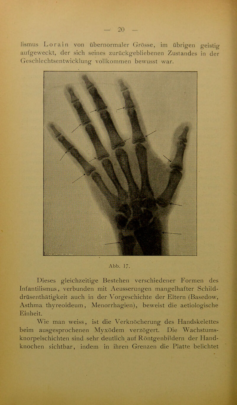 lismus Lorain von übernormaler Grösse, im übrigen geistig aufgeweckt, der sicli seines zurückgebliebenen Zustandes in der Geschlechtsentwicklung vollkommen bewusst war. Abb. 17. Dieses gleichzeitige Bestehen verschiedener Formen des Infantilismus, verbunden mit Aeusserungen mangelhafter Schild- drüsenthätigkeit auch in der Vorgeschichte der Eltern (Basedow, Asthma thyreoideum, Menorrhagien), beweist die aetiologische Einheit. Wie man weiss, ist die Verknöcherung des Handskelettes beim ausgesprochenen Myxödem verzögert. Die Wachstums- knorpelschichten sind sehr deutlich auf Röntgenbildern der Hand- knochen sichtbar, indem in ihren Grenzen die Platte belichtet