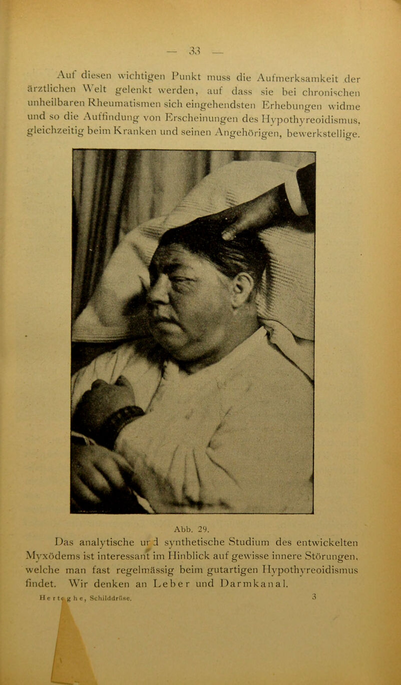 Aut diesen wichtigen Punkt muss die Aufmerksamkeit der ärztlichen Welt gelenkt werden, auf dass sie bei chronischen unheilbaren Rheumatismen sich eingehendsten Erhebungen widme und so die Auttindung von Erscheinungen des Hypothyreoidismus, gleichzeitig beim Kranken und seinen Angehörigen, bewerkstellige. Abb. 29. Das analytische ur d synthetische Studium des entwickelten Myxödems ist interessant im Hinblick auf gewisse innere Störungen, welche man fast regelmässig beim gutartigen Hypothyreoidismus findet. Wir denken an Leber und Darmkanal. Hertcghe, Schilddrüse. 3