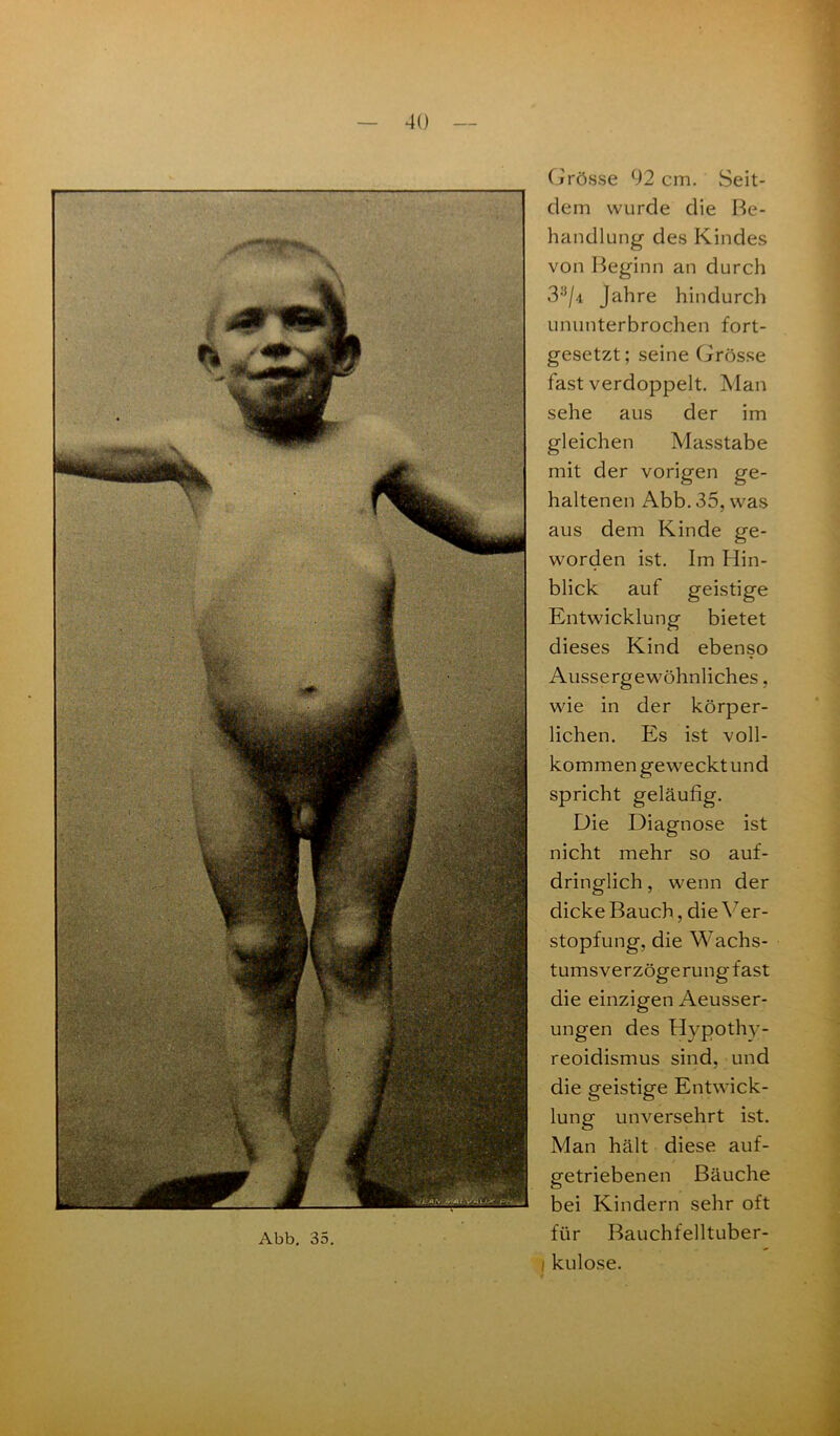 Abb. 35. Grösse 92 cm. Seit- dem wurde die Be- handlung des Kindes von Beginn an durch 3:i/4 Jahre hindurch ununterbrochen fort- gesetzt; seine Grösse fast verdoppelt. Man sehe aus der im gleichen Masstabe mit der vorigen ge- haltenen Abb. 35, was aus dem Kinde ge- worden ist. Im Hin- blick auf geistige Entwicklung bietet dieses Kind ebenso Aussergewöhnliches, wie in der körper- lichen. Es ist voll- kommen geweckt und spricht geläufig. Die Diagnose ist nicht mehr so auf- dringlich , wenn der dicke Bauch, die Ver- stopfung, die Wachs- tumsverzögerungfast die einzigen Aeusser- ungen des Hypothy- reoidismus sind, und die geistige Entwick- lung unversehrt ist. Man hält diese auf- getriebenen Bäuche bei Kindern sehr oft für Bauchfelltuber- i kulose.