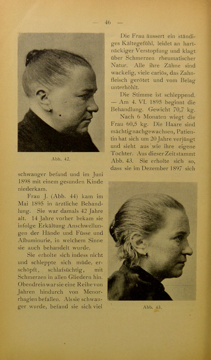 schwanger befand und im Juni 1898 mit einem gesunden Kinde niederkam. Frau J. (Abb. 44) kam im Mai 1895 in ärztliche Behand- lung. Sie war damals 42 Jahre alt. 14 Jahre vorher bekam sie infolge Erkältung Anschwellun- gen der Hände und Füsse und Albuminurie, in welchem Sinne sie auch behandelt wurde. Sie erholte sich indess nicht und schleppte sich müde, er- schöpft, schlafsüchtig, mit Schmerzen in allen Gliedern hin. Obendrein war sie eine Reihe von Jahren hindurch von Menor- rhagienbefallen. Alssie schwan- Die Frau äussert ein ständi- ges Kältegefühl, leidet an hart- näckiger Verstopfung und klagt über Schmerzen rheumatischer Natur. Alle ihre Zähne sind wackelig, viele cariös, das Zahn- fleisch gerötet und vom Belag unterhöhlt. Die Stimme ist schleppend. — Am 4. VI. 1895 beginnt die Behandlung. Gewicht 70,7 kg. Nach 6 Monaten wiegt die Frau 60,5 kg. Die Haare sind mächtig nachgewachsen, Patien- tin hat sich um 20 Jahre verjüngt und sieht aus wie ihre eigene Tochter. Aus dieser Zeit stammt Abb. 43. Sie erholte sich so, dass sie im Dezember 1897 sich
