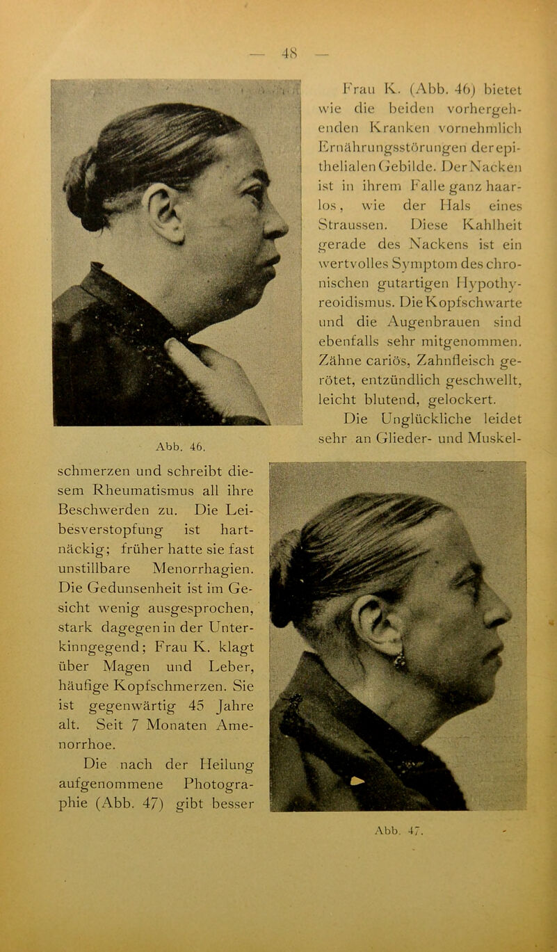 Abb. 46. Frau K. (Abb. 46) bietet wie die beiden vorhergeh- enden Kranken vornehmlich Ernährungsstörungen der epi- thelialen Gebilde. DerNacken ist in ihrem Falle ganz haar- los , wie der Hals eines Straussen. Diese Kahlheit gerade des Nackens ist ein wertvolles Symptom des chro- nischen gutartigen Hypothy- reoidismus. Die Kopfschwarte und die Augenbrauen sind ebenfalls sehr mitgenommen. Zähne cariös, Zahnfleisch ge- rötet, entzündlich geschwellt, leicht blutend, gelockert. Die Unglückliche leidet sehr an Glieder- und Muskel- schmerzen und schreibt die- sem Rheumatismus all ihre Beschwerden zu. Die Lei- besverstopfung ist hart- näckig; früher hatte sie fast unstillbare Menorrhagien. Die Gedunsenheit ist im Ge- sicht wenig ausgesprochen, stark dagegen in der Unter- kinngegend; Frau K. klagt über Magen und Leber, häufige Kopfschmerzen. Sie ist gegenwärtig 45 Jahre alt. Seit 7 Monaten Ame- norrhoe. Die nach der Heilung aufgenommene Photogra- phie (Abb. 47) gibt besser
