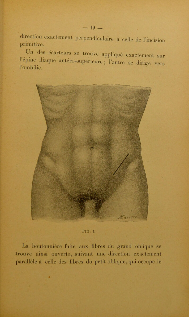 direction exactement primitive. Un des écarteurs Fépine iliaque antéro l’ombilic. perpendiculaire à celle de l’incision se trouve appliqué exactement sur -supérieure ; 1’auti‘c se dirige vers Fig. 1. La boutonnière faite aux fibres du gaviiul ol)li(jue se trouve ainsi ouverte, suivant une direction exact(unent [larallèle à celle des fibres du petit ol)li(pie, qui occupe le 4 \