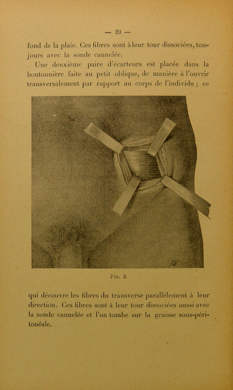 fond de la plaie. Ces fibres sont à leur tour dissociées, tou- jours avec la sonde cannelée. Une deuxième paire d’écarteurs esl placée dans la boutonnière laite au petit oblique, de manière à l’ouvrir transversalement par rapport au corps de l’individu ; ce Fig, 2. qui découvj*e les fibres du transverse parallèlement à leur direction. Ces fibres sont à leur tour dissociées aussi avec la sonde cannelée et l’on tombe sur la graisse sous-péri- tonéale.