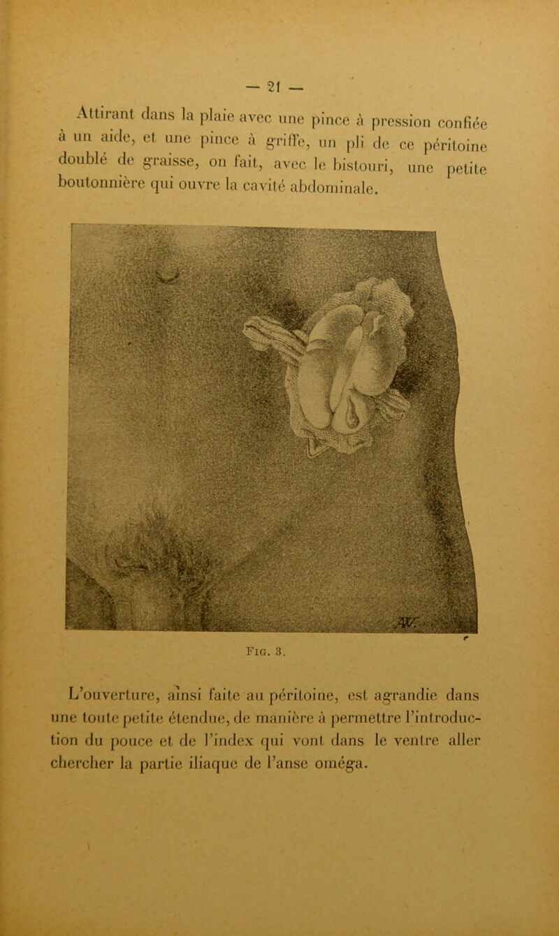 Attirant dans la plaie avec une pince à pression confiée a un aide, et une pince à grille, un [)li de ce péritoine doublé de graisse, on lait, avec le bistouri, une petite boutonnière cpii ouvre la cavité abdominale. L’ouverture, ainsi faite au péritoine, est agrandie dans une toute petite étendue, de manière à permettre l’introduc- tion du pouce et de l’index qui vont dans le venire aller chercher la partie iliaque de l’anse oméga.