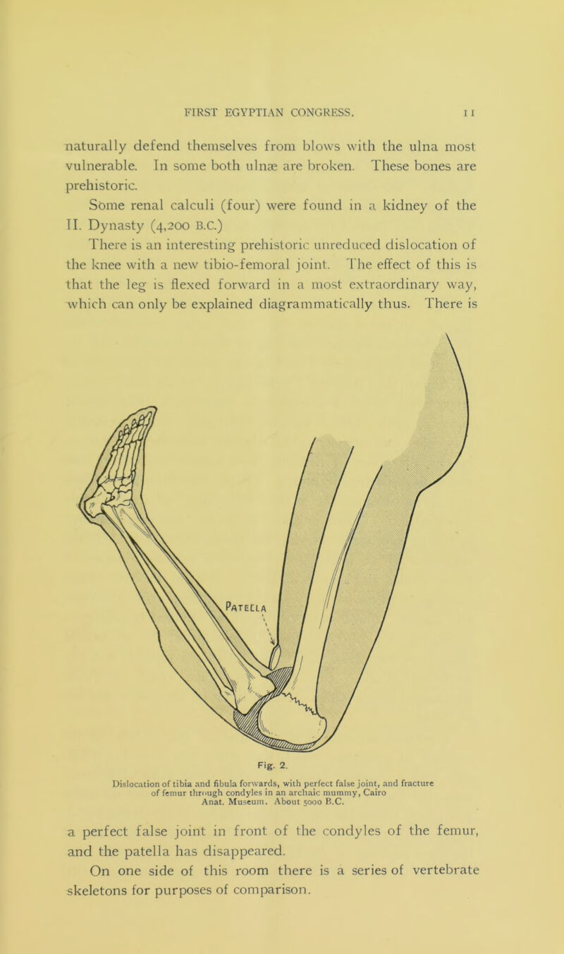 naturally defend themselves from blows with the ulna most vulnerable. In some both ulnae are broken. These bones are prehistoric. Some renal calculi (four) were found in a kidney of the II. Dynasty (4,200 B.C.) There is an interesting prehistoric unreduced dislocation of the knee with a new tibio-femoral joint. The effect of this is that the leg is flexed forward in a most extraordinary way, which can only be explained diagrammatically thus. There is Dislocation of tibia and fibula forwards, with perfect false joint, and fracture of femur through condyles in an archaic mummy, Cairo Anat. Museum. About 5000 B.C. a perfect false joint in front of the condyles of the femur, and the patella has disappeared. On one side of this room there is a series of vertebrate skeletons for purposes of comparison.