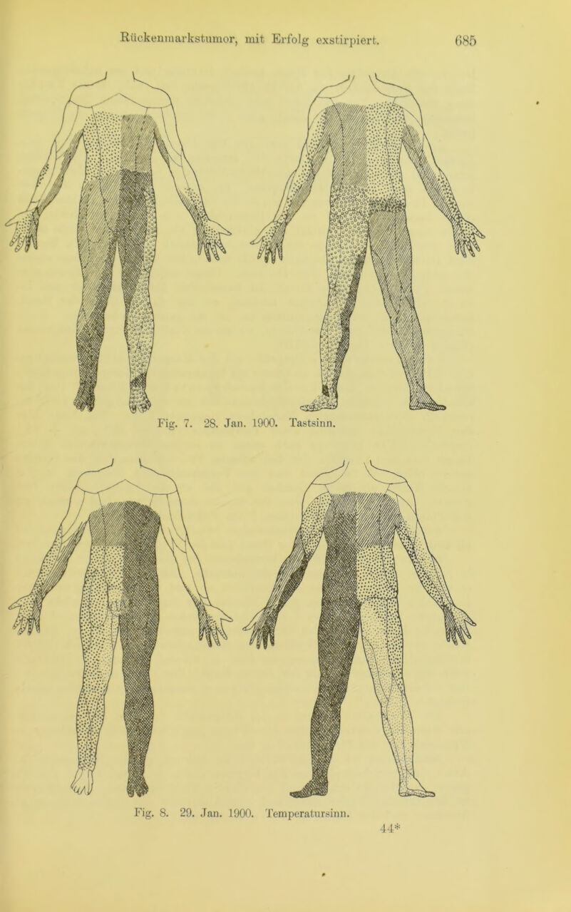 Rückeiimarkstnmor, mit Eribl g exstirpiert. ()S5 Fig. 7. 28. Jan. 1900. Tastsinn. Fig. 8. 29. Jan. 1900. Temperatnr.^inn. 44*
