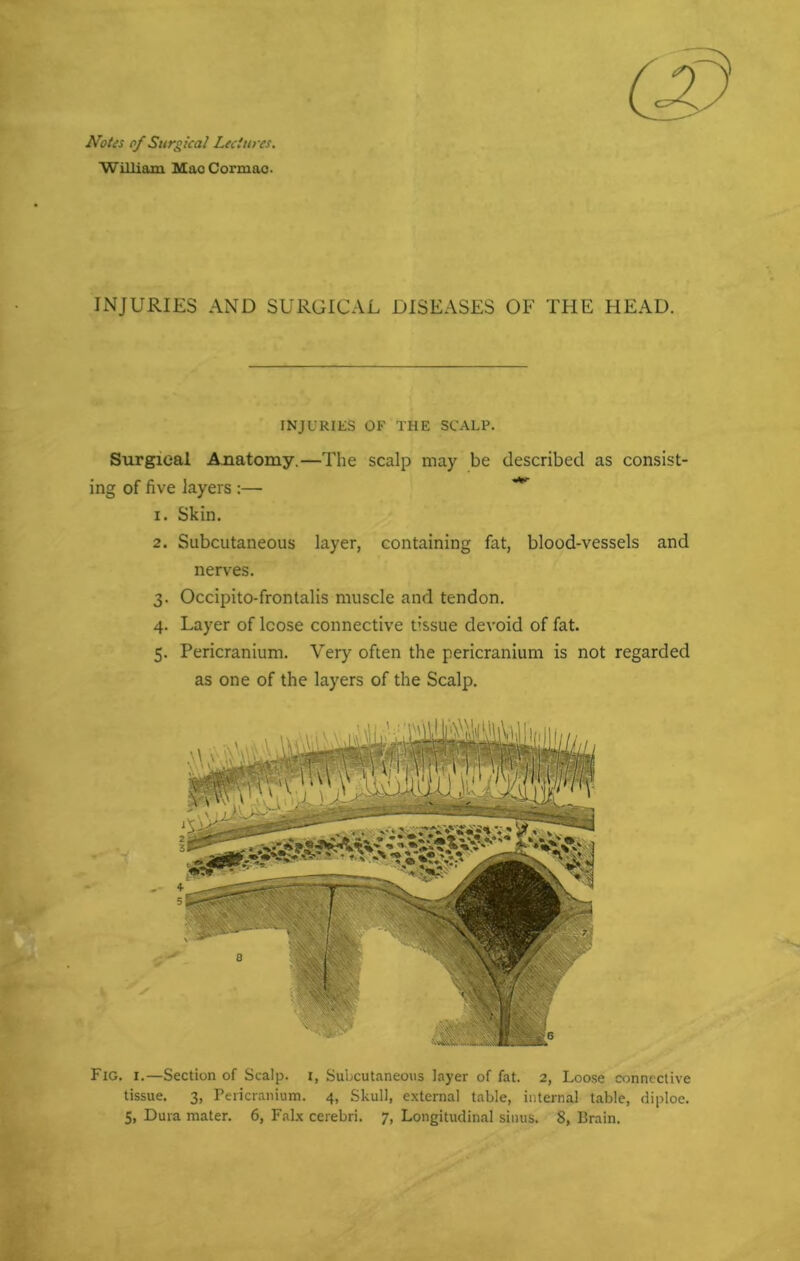 Notes cf Surgical Lectures. William Mac Cormao. INJURIES AND SURGICAL DISEASES OF THE HEAD. INJURIES OF THE SCALP. Surgical Anatomy.—The scalp may be described as consist- ing of five layers :— ** 1. Skin. 2. Subcutaneous layer, containing fat, blood-vessels and nerves. 3. Occipito-frontalis muscle and tendon. 4. Layer of lcose connective tissue devoid of fat. 5. Pericranium. Very often the pericranium is not regarded as one of the layers of the Scalp. Fig. 1.—Section of Scalp, i, Subcutaneous layer of fat. 2, Loose connective tissue. 3, Pericranium. 4, Skull, external table, internal table, diploe. 5, Dura mater. 6, Falx cerebri. 7, Longitudinal sinus. 8, Brain.