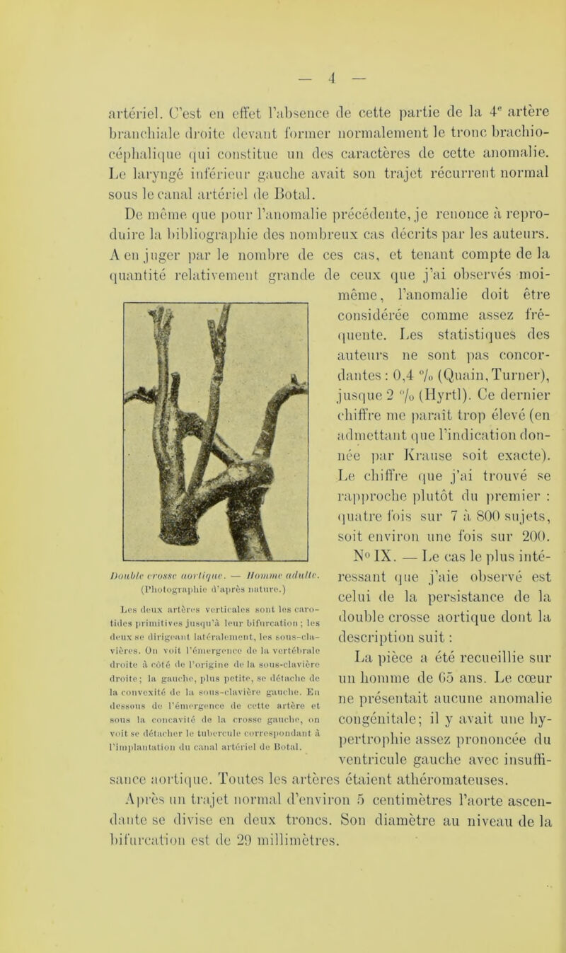 artériel. C’est en effet ral)sence de cette partie de la 4-® artère branchiale droite devant former nornialeinent le tronc brachio- céphali(ine (pii constitue nn des caractères de cette anomalie. Le laryngé inférieur gauche avait son trajet récurrent normal sous le canal artériel de llotal. De même (pie pour l’anomalie précédente, je renonce à repro- duire la bibliographie des nombreux cas décrits par les auteurs. A en juger parle nombre de ces cas, et tenant compte de la (piantité relativement grande de ceux (jue j’ai observés moi- môme, l’anomalie doit être considérée comme assez fré- (piente. Les statisti(]ues des auteurs ne sont pas concor- dantes : 0,4 7o (Qnain,Turner), jus(]ue 2 7o (Hyrtl). Ce dernier chiffre me paraît trop élevé (en admettant (]ue l’indication don- née jiar Krause soit exacte). Le chiffre (pie j’ai trouvé se rapproche plutôt du premier : (plâtre l'ois sur 7 à SOO sujets, soit environ une fois sur 200. N» IX. — Le cas le plus inté- ressant (]ue j’aie observé est celui de la persistance de la double crosse aortique dont la desci’iption suit : La pièce a été recueillie sur un homme de 05 ans. Le cœur ne présentait aucune anomalie congénitale; il y avait une by- ])ertropbie assez prononcée du ventricule gauche avec insuffi- sance aorti(pie. Toutes les artères étaient athéromateuses. Après un trajet normal d’environ 5 centimètres l’aorte ascen- dante se divise en deux troncs. Son diamètre au niveau de la bifurcation est de 29 millimètres. Double vrosse aoiiirjue. — Homme adulte. (l’hutogriviiliie il'après iiatuvo.) Les ilou.x artères verticales sont les earo- tiiles primitives jusqu'à leur bifurcation; les (leux se dirigeant latéralement, les sous-cla- vières. Ou voit l’émergence de la vertébrale droite à côté do l’origine de la sous-clavière droite; la gauche, [dus petite, se détache de la convexité de la sous-clavière gauche. Eu dessous de rémergencc de cette artère et BOUS la concavité de la crosse gauche, on voit se détacher le tubercule corres]iondant à l’imidanlation du canal artériel do liotiil.