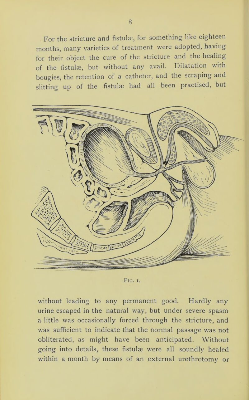 For the stricture and fistuhe, for something like eighteen months, many varieties of treatment were adopted, having for their object the cure of the stricture and the healing of the fistulae, but without any avail. Dilatation with bougies, the retention of a catheter, and the scraping and slitting up of the fistulae had all been practised, but Fig. I. without leading to any permanent good. Hardly any urine escaped in the natural way, but under severe spasm a little was occasionally forced through the stricture, and was sufficient to indicate that the normal passage was not obliterated, as might have been anticipated. Without going into details, these fistulge were all soundly healed within a month by means of an external urethrotomy or