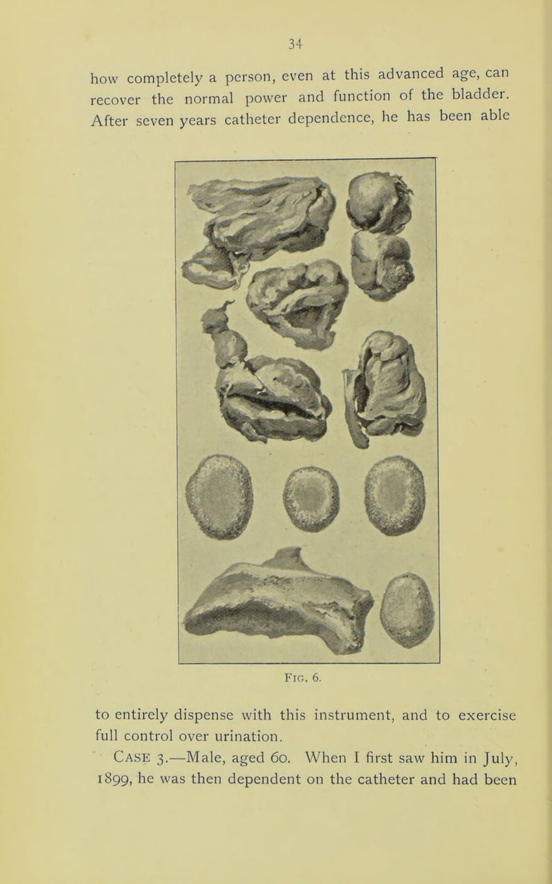 how completely a person, even at this advanced age, can recover the normal power and function of the bladder. After seven years catheter dependence, he has been able Fig. 6. to entirely dispense with this instrument, and to exercise full control over urination. Case 3.—Male, aged 60. When I first saw him in July, 1899, he was then dependent on the catheter and had been