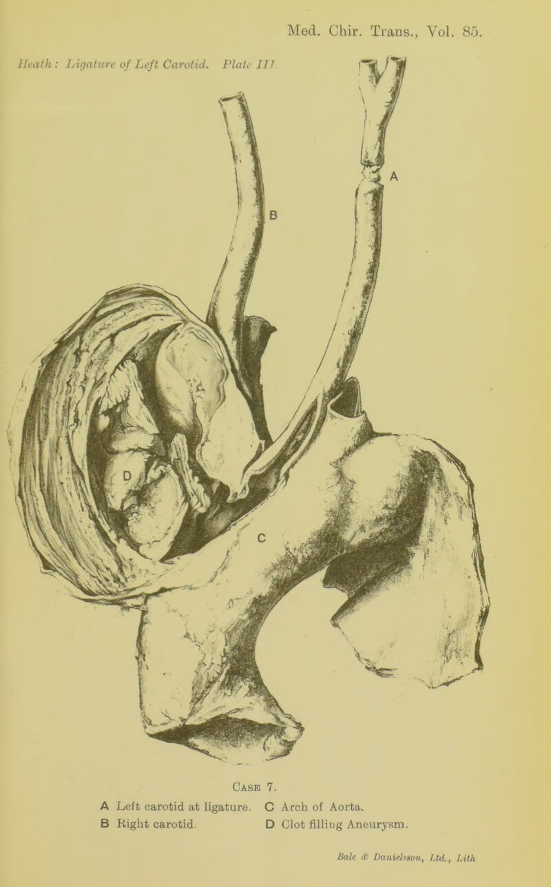 A Left carotid at ligature. C Arch of Aorta. B Right carotid. D Clot filling Aneurysm.