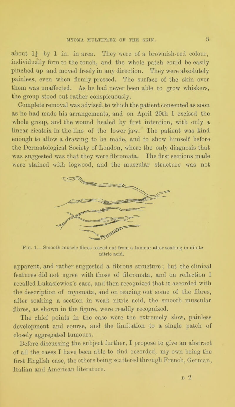 about 1A by 1 in. in area. They were of a brownish-red colour, individually firm to the touch, and the whole patch could be easily pinched up and moved freely in any direction. They were absolutely painless, even when firmly pressed. The surface of the skin over them was unaffected. As he had never been able to grow whiskers, the group stood out rather conspicuously. Complete removal was advised, to which the patient consented as soon as he had made his arrangements, and on April 20th I excised the whole group, and the wound healed by first intention, with only a linear cicatrix in the line of the lower jaw. The patient was kind enough to allow a drawing to be made, and to show himself before the Dermatological Society of London, where the only diagnosis that was suggested was that they were fibromata. The first sections made were stained with logwood, and the muscular structure was not Fig. 1.—Smooth muscle fibres teazed out from a tumour after soaking in dilute nitric acid. apparent, and rather suggested a fibrous structure; but the clinical features did not agree with those of fibromata, and on reflection I recalled Lukasiewicz’s case, and then recognized that it accorded with the description of myomata, and on teazing out some of the fibres, after soaking a section in weak nitric acid, the smooth muscular fibres, as shown in the figure, were readily recognized. The chief points in the case were the extremely slow, painless development and course, and the limitation to a single patch of closely aggregated tumours. Before discussing the subject further, I propose to give an abstract of all the cases I have been able to find recorded, my own being the first English case, the others being scattered through French, German, Italian and American literature. b 2