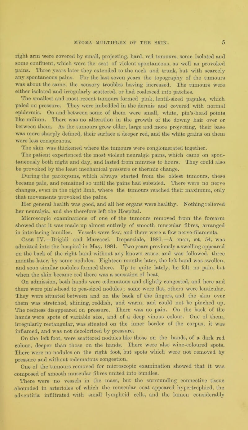 right arm wro covered by small, projecting, hard, red tumours, some isolated and some confluent, which were the seat of violent spontaneous, as well as provoked pains. Three years later they extended to the neck and trunk, but with scarcely any spontaneous pains. For the last seven years the topography of the tumours was about the same, the sensory troubles having increased. The tumours were either isolated and irregularly scattered, or had coalesced into patches. The smallest and most recent tumours formed pink, lentil-sized papules, which paled on pressure. They were imbedded in the dermis and covered with normal epidermis. On and between some of them were small, white, pin’s-head points like milium. There was no alteration in the growth of the downy hair over or between them. As the tumours grew older, large and more projecting, their base was more sharply defined, then surface a deeper red, and the white grains on them were less conspicuous. The skin was thickened where the tumours were conglomerated together. The patient experienced the most violent neuralgic pains, which came on spon- taneously both night and day, and lasted from minutes to hours. They could also be provoked by the least mechanical pressure or thermic change. During the paroxysms, which always started from the oldest tumours, these became pale, and remained so until the pains had subsided. There were no nerve changes, even in the right limb, where the tumours reached their maximum, only that movements provoked the pains. Her general health was good, and all her organs were healthy. Nothing relieved her neuralgia, and she therefore left the Hospital. Microscopic examinations of one of the tumours removed from the forearm showed that it was made up almost entirely of smooth muscular fibres, arranged in interlacing bundles. Vessels were few, and there were a few nerve-filaments. Case IV.—Brigidi and Marcacci. Imparziale, 1881.—A man, set. 54, was admitted into the hospital in May, 1881. Two years previously a swelling appeared on the back of the right hand without any known cause, and was followed, three months later, by some nodules. Eighteen months later, the left hand was swollen, and soon similar nodules formed there. Up to quite lately, he felt no pain, but when the skin became red there was a sensation of heat. On admission, both hands were oedematous and slightly congested, and here and there were pin’s-head to pea-sized nodules ; some were flat, others were lenticular. They were situated between and on the back of the fingers, and the skin over them was stretched, shining, reddish, and warm, and could not be pinched up. The redness disappeared on pressure. There was no pain. On the back of the hands were spots of variable size, and of a deep vinous colour. One of them, irregularly rectangular, was situated on the inner border of the carpus, it was inflamed, and was not decolorized by pressure. On the left foot, were scattered nodules like those on the hands, of a dark red colour, deeper than those on the hands. There were also wine-coloured spots. There were no nodules on the right foot, but spots which were not removed by pressure and without oedematous congestion. One of the tumours removed for microscopic examination showed that it was composed of smooth muscular fibres united into bundles. There were no vessels in the mass, but the surrounding connective tissue abounded in arterioles of which the muscular coat appeared hypertrophied, the adventitia infiltrated with small lymphoid cells, and the lumen considerably