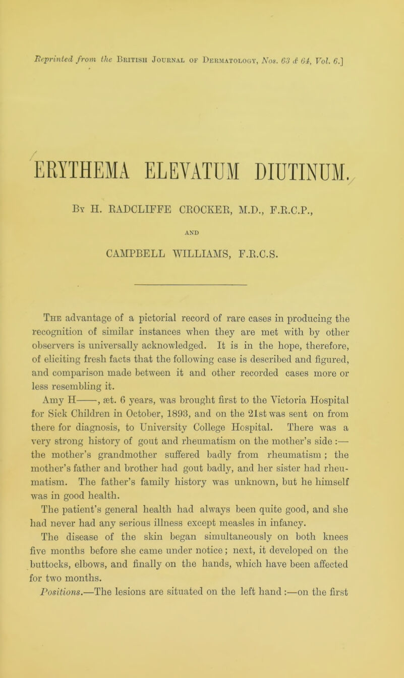 Reprinted from the British Journal of Dermatology, Nos. 63 <£ 64, Vol. £.] ERYTHEMA ELEYATUM DIUTINUM. By H. RADCLIFFE CROCKER, M.D., F.R.C.P., AND CAMPBELL WILLIAMS, F.R.C.S. The advantage of a pictorial record of rare cases in producing the recognition of similar instances when they are met with by other observers is universally acknowledged. It is in the hope, therefore, of eliciting fresh facts that the following case is described and figured, and comparison made between it and other recorded cases more or less resembling it. Amy H •, fet. 6 years, was brought first to the Victoria Hospital for Sick Children in October, 1893, and on the 21st was sent on from there for diagnosis, to University College Hospital. There was a very strong history of gout and rheumatism on the mother’s side :— the mother’s grandmother suffered badly from rheumatism ; the mother’s father and brother had gout badly, and her sister had rheu- matism. The father’s family history was unknown, but he himself was in good health. The patient’s general health had always been quite good, and she had never had any serious illness except measles in infancy. The disease of the skin began simultaneously on both knees five months before she came under notice; next, it developed on the buttocks, elbows, and finally on the hands, which have been affected for two months. Positions.—The lesions are situated on the left hand :—on the first