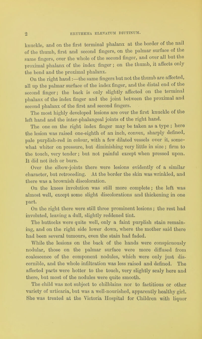 knuckle, and on the first terminal phalanx at the border of the nail of the thumb, first and second fingers, on the palmar surface of the same fingers, over the whole of the second finger, and over all but the proximal phalanx of the index finger ; on the thumb, it affects only the bend and the proximal phalanx. On the right hand :—the same fingers but not the thumb are affected, all up the palmar surface of the index finger, and the distal end of the second finger; the back is only slightly affected on the terminal phalanx of the index finger and the joint between the proximal and second phalanx of the first and second fingers. The most highly developed lesions are over the first knuckle of the left hand and the inter-phalangeal joints of the right hand. The one on the right index finger may be taken as a type ; here the lesion was raised one-eighth of an inch, convex, sharply defined, pale purplish-red in colour, with a few dilated vessels over it, some- what whiter on pressure, but diminishing very little in size ; firm to the touch, very tender ; but not painful except when pressed upon. It did not itch or burn. Over the elbow-joints there were lesions evidently of a similar character, but retroceding. At the border the skin was wrinkled, and there was a brownish discoloration. On the knees involution was still more complete ; the left was almost well, except some slight discolorations and thickening in one part. On the right there were still three prominent lesions; the rest had involuted, leaving a dull, slightly reddened tint. The buttocks were quite well, only a faint purplish stain remain- ing, and on the right side lower down, where the mother said there had been several tumours, even the stain had faded. While the lesions on the back of the hands were conspicuously nodular, those on the palmar surface were more diffused from coalescence of the component nodules, which were only just dis- cernible, and the whole infiltration was less raised and defined. The affected parts were hotter to the touch, very slightly scaly here and there, but most of the nodules were quite smooth. The child was not subject to chilblains nor to factitious or other variety of urticaria, but was a well-nourished, apparently healthy girl. She was treated at the Victoria Hospital for Children with liquor