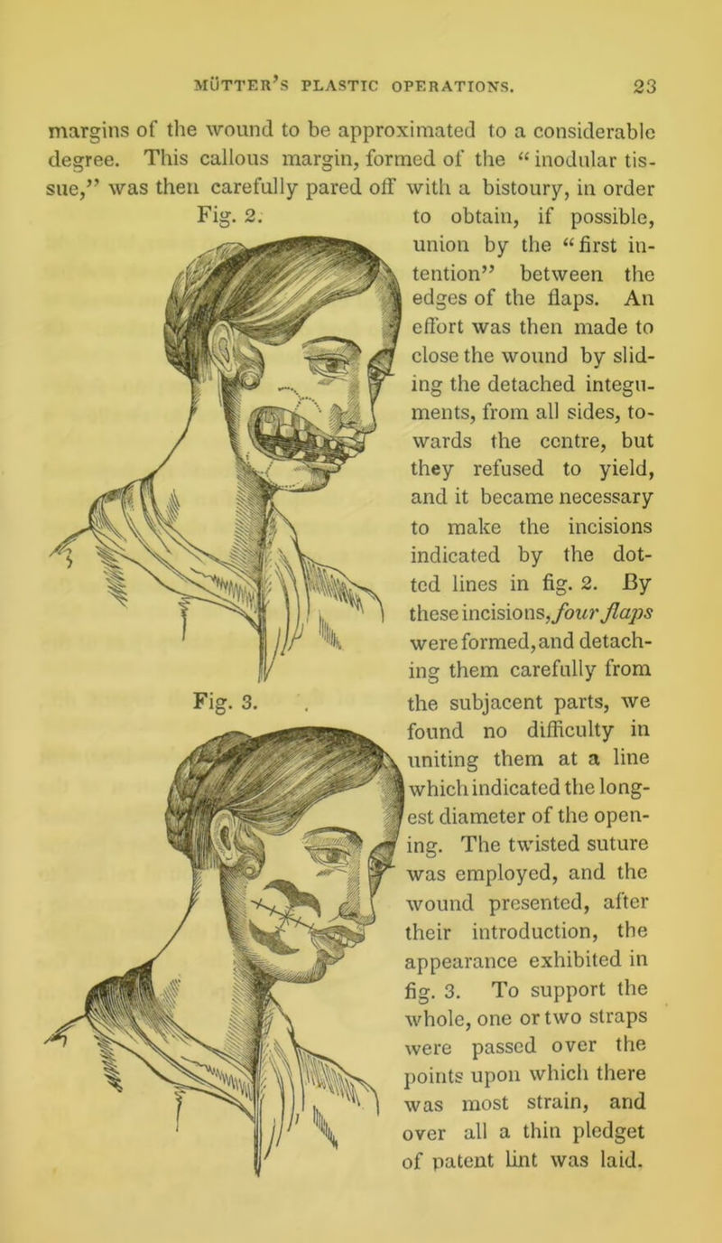margins of the wound to be approximated to a considerable degree. This callous margin, formed of the “ modular tis- sue,” was then carefully pared off with a bistoury, in order Fig. 2. to obtain, if possible, union by the “first in- tention” between the edges of the flaps. An effort was then made to close the wound by slid- ing the detached integu- ments, from all sides, to- wards the centre, but they refused to yield, and it became necessary to make the incisions indicated by the dot- ted lines in fig. 2. By these incisions, four flaps were formed, and detach- ing them carefully from Fig. 3. . the subjacent parts, we found no difficulty in uniting them at a line which indicated the long- est diameter of the open- ing. The twisted suture was employed, and the wound presented, after their introduction, the appearance exhibited in fig. 3. To support the whole, one or two straps were passed over the points upon which there was most strain, and over all a thin pledget of patent lint was laid.