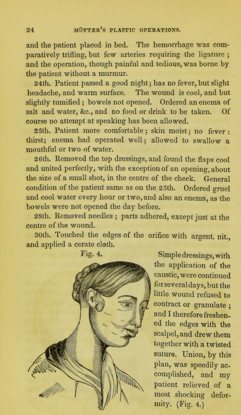 and the patient placed in bed. The hemorrhage was com- paratively trifling, but few arteries requiring the ligature ; and the operation, though painful and tedious, was borne by the patient without a murmur. 24th. Patient passed a good night; has no fever, but slight headache, and warm surface. The wound is cool, and but slightly tumified ; bowels not opened. Ordered an enema of salt and water, &c., and no food or drink to be taken. Of course no attempt at speaking has been allowed. 25th. Patient more comfortable; skin moist; no fever: thirst; enema had operated well; allowed to swallow a mouthful or two of water. 26th. Removed the top dressings, and found the flaps cool and united perfectly, with the exception of an opening, about the size of a small shot, in the centre of the cheek. General condition of the patient same as on the 25th. Ordered gruel and cool water every hour or two, and also an enema, as the bowels were not opened the day before. 28th. Removed needles ; parts adhered, except just at the centre of the wound. 30th. Touched the edges of the orifice with argent, nit., and applied a cerate cloth. Fig* 4. Simple dressings, with the application of the caustic, were continued for several days, but the little wound refused to contract or granulate ; and I therefore freshen- ed the edges with the scalpel, and drew them together with a twisted suture. Union, by this plan, was speedily ac- complished, and my patient relieved of a most shocking defor- mity. (Fig. 4.)