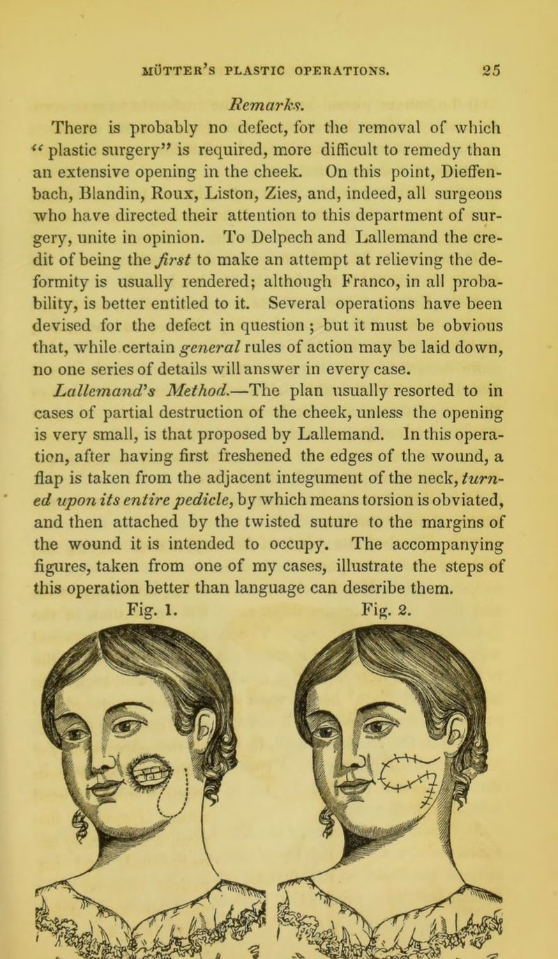 Remarks. There is probably no defect, for the removal of which i( plastic surgery” is required, more difficult to remedy than an extensive opening in the cheek. On this point, Dieffen- bach, Blandin, Roux, Liston, Zies, and, indeed, all surgeons who have directed their attention to this department of sur- gery, unite in opinion. To Delpech and Lallemand the cre- dit of being the first to make an attempt at relieving the de- formity is usually rendered; although Franco, in all proba- bility, is better entitled to it. Several operations have been devised for the defect in question ; but it must be obvious that, while certain general rules of action may be laid down, no one series of details will answer in every case. Lallemand’s Method.—The plan usually resorted to in cases of partial destruction of the cheek, unless the opening is very small, is that proposed by Lallemand. In this opera- tion, after having first freshened the edges of the wound, a flap is taken from the adjacent integument of the neck, turn- ed upon its entire pedicle, by which means torsion is obviated, and then attached by the twisted suture to the margins of the wound it is intended to occupy. The accompanying figures, taken from one of my cases, illustrate the steps of this operation better than language can describe them. Fig. 1. Fig. 2.