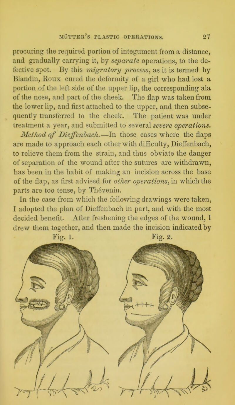 procuring the required portion of integument from a distance, and gradually carrying it, by separate operations, to the de- fective spot. By this migratory process, as it is termed by Blandin, Roux cured the deformity of a girl who had lost a portion of the left side of the upper lip, the corresponding ala of the nose, and part of the cheek. The flap was taken from the lower lip, and first attached to the upper, and then subse- quently transferred to the cheek. The patient was under treatment a year, and submitted to several severe operations. Method of Dieffenbach.—In those cases where the flaps are made to approach each other with difficulty, Dieffenbach, to relieve them from the strain, and thus obviate the danger of separation of the wound after the sutures are withdrawn, has been in the habit of making an incision across the base of the flap, as first advised for other operations, in which the parts are too tense, by Thevenin. In the case from which the following drawings were taken, I adopted the plan of Dieffenbach in part, and with the most decided benefit. After freshening the edges of the wound, I drew them together, and then made the incision indicated by Fig. 1. Fig. 2.