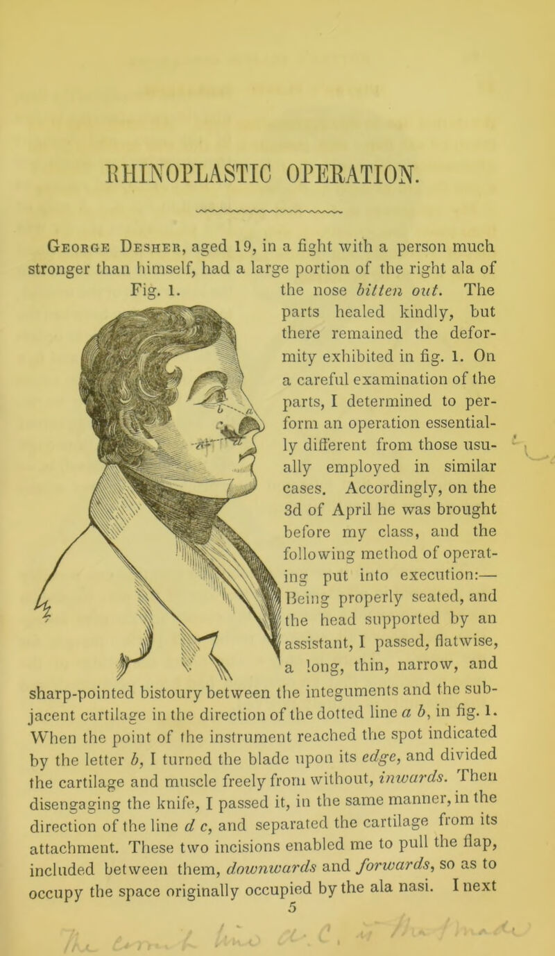 George Desher, aged 19, in a fight with a person much stronger than himself, had a large portion of the right ala of Fig. 1. the nose bitten out. The parts healed kindly, but there remained the defor- mity exhibited in fig. 1. On a careful examination of the parts, I determined to per- form an operation essential- ly different from those usu- ally employed in similar cases. Accordingly, on the 3d of April he was brought before my class, and the following method of operat- ing put into execution:— 13eing properly seated, and the head supported by an assistant, I passed, flatwise, a long, thin, narrow, and sharp-pointed bistoury between the integuments and the sub- jacent cartilage in the direction of the dotted line a b, in fig. 1. When the point of the instrument reached the spot indicated by the letter b, I turned the blade upon its edge, and divided the cartilage and muscle freely from without, inwards. Then disengaging the knife, I passed it, in the same manner, in the direction of the line d c, and separated the cartilage fiom its attachment. These two incisions enabled me to pull the flap, included between them, downwards and forwards, so as to occupy the space originally occupied by the ala nasi. I next