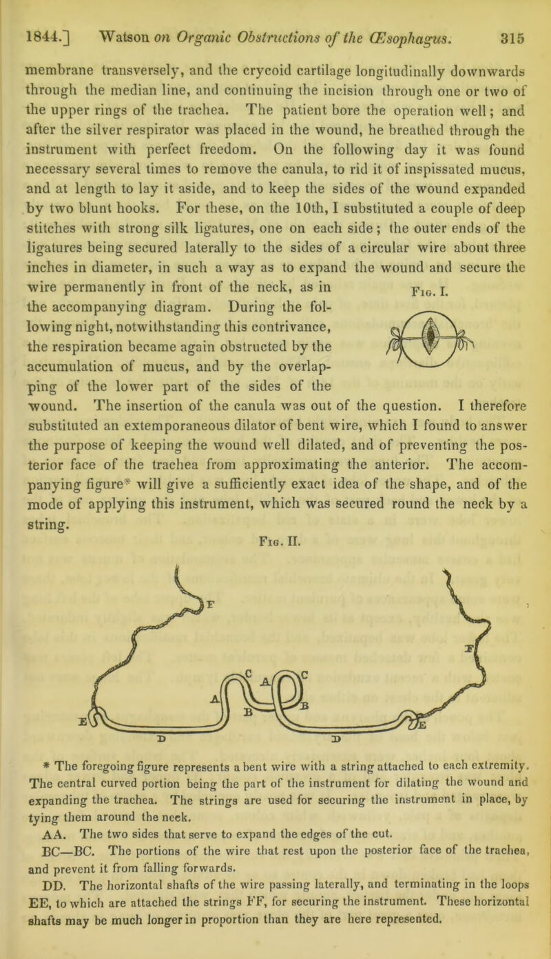 membrane transversely, and the crycoid cartilage longitudinally downwards through the median line, and continuing the incision through one or two of the upper rings of the trachea. The patient bore the operation well; and after the silver respirator was placed in the wound, he breathed through the instrument with perfect freedom. On the following day it was found necessary several times to remove the canula, to rid it of inspissated mucus, and at length to lay it aside, and to keep the sides of the wound expanded by two blunt hooks. For these, on the 10th, I substituted a couple of deep stitches with strong silk ligatures, one on each side; the outer ends of the ligatures being secured laterally to the sides of a circular wire about three inches in diameter, in such a way as to expand the wound and secure the wire permanently in front of the neck, as in the accompanying diagram. During the fol- lowing night, notwithstanding this contrivance, the respiration became again obstructed by the accumulation of mucus, and by the overlap- ping of the lower part of the sides of the wound. The insertion of the canula was out of the question. I therefore substituted an extemporaneous dilator of bent wire, which I found to answer the purpose of keeping the wound well dilated, and of preventing the pos- terior face of the trachea from approximating the anterior. The accom- panying figure* will give a sufficiently exact idea of the shape, and of the mode of applying this instrument, which was secured round the neck by a string. Fig. II. a> * The foregoing figure represents a bent wire with a string attached to each extremity. The central curved portion being the part of the instrument for dilating the wound and expanding the trachea. The strings are used for securing the instrument in place, by tying them around the neck. AA. The two sides that serve to expand the edges of the cut. BC—BC. The portions of the wire that rest upon the posterior face of the trachea, and prevent it from falling forwards. DD. The horizontal shafts of the wire passing laterally, and terminating in the loops EE, to which are attached the strings FF, for securing the instrument. These horizontal shafts may be much longer in proportion than they are here represented.