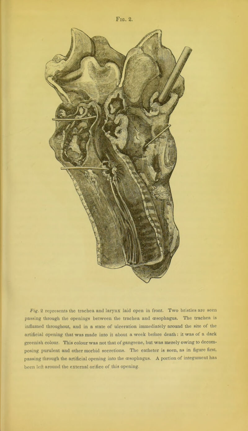 Fig. 2 represents the trachea and larynx laid open in front. Two bristles are seen passing through the openings between the trachea and oesophagus. The trachea is inflamed throughout, and in a state of ulceration immediately around the site of the artificial opening that was made into it about a week before death: it was of a dark greenish colour. This colour was not that of gangrene, but was merely owing to decom- posing purulent and other morbid secretions. The catheter is seen, as in figure first, passing through the artificial opening into the oesophagus. A portion of integument has been left around the external orifice of this opening.