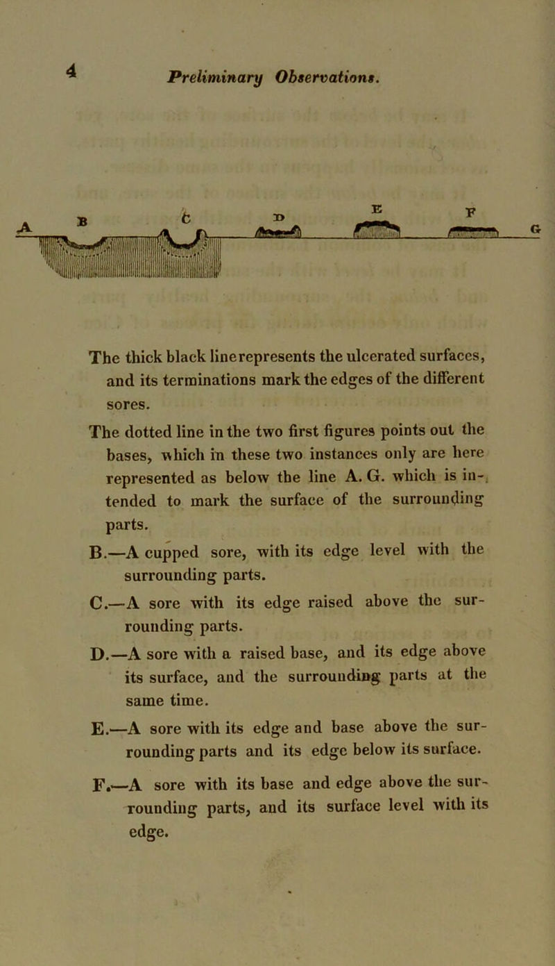 The thick black linerepresents the ulcerated surfaces, and its terminations mark the edges of the different sores. The dotted line in the two first figures points out the bases, which in these two instances only are here represented as below the line A. G. which is in- tended to mark the surface of the surrounding parts. B. —A cupped sore, with its edge level with the surrounding parts. C. —A sore with its edge raised above the sur- rounding parts. D. —A sore with a raised base, and its edge above its surface, and the surrounding parts at the same time. E—A sore with its edge and base above the sur- rounding parts and its edge below its surface. F.—A sore with its base and edge above the sur- rounding parts, and its surface level with its edge.