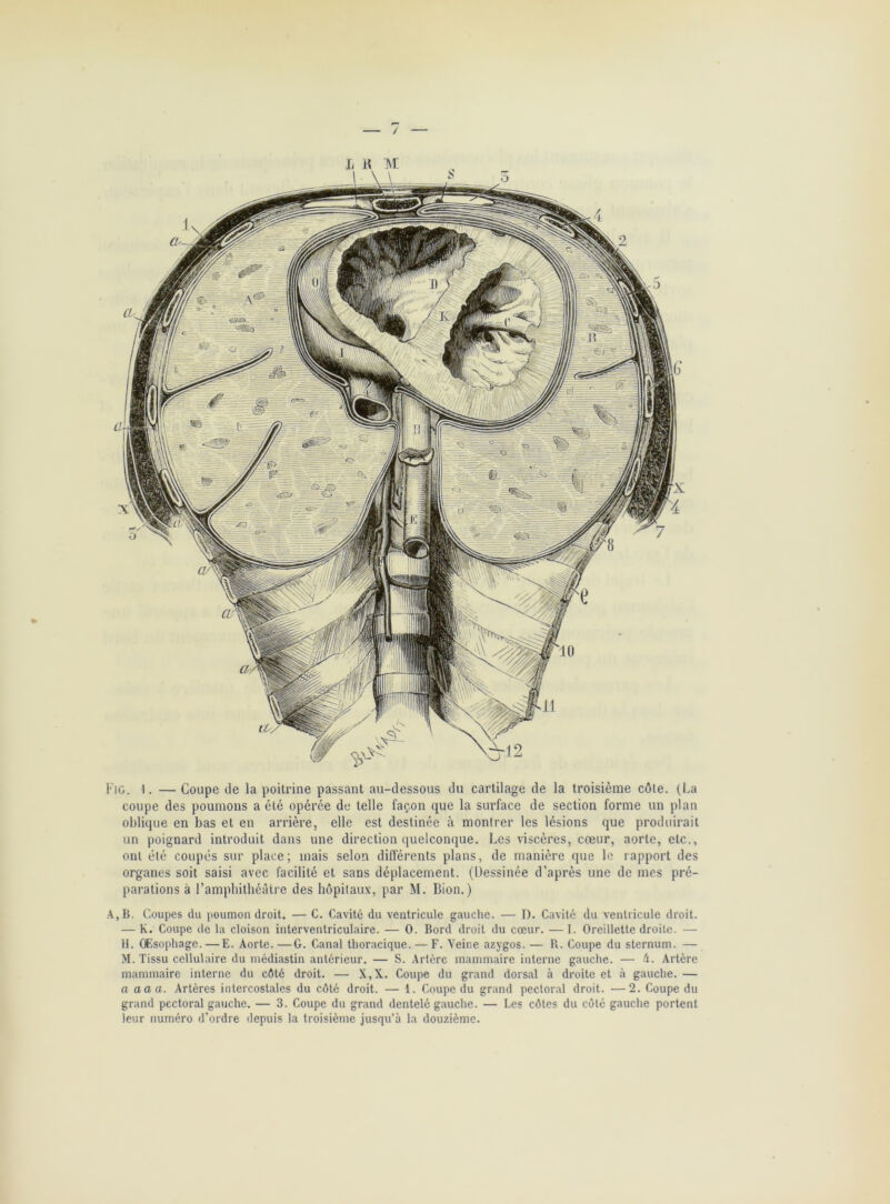 / Fig. I. — Coupe de la poitrine passant au-dessous du cartilage de la troisième côte. (La coupe des poumons a été opérée de telle façon que la surface de section forme un plan oblique en bas et en arrière, elle est destinée à montrer les lésions que produirait un poignard introduit dans une direction quelconque. Les viscères, cœur, aorte, etc., ont été coupés sur place; mais selon différents plans, de manière que le rapport des organes soit saisi avec facilité et sans déplacement. (Dessinée d’après une de mes pré- parations à l’amphithéâtre des hôpitaux, par M. Bion.) A, B. Coupes du poumon droit. — C. Cavité du ventricule gauche. — D. Cavité du ventricule droit. — K. Coupe de la cloison interventriculaire. — 0. Bord droit du cœur. — I. Oreillette droite. — H. Œsophage. — E. Aorte.—G. Canal thoracique. — F. Veine azygos. — R. Coupe du sternum. — M. Tissu cellulaire du médiastin antérieur. — S. Artère mammaire interne gauche. — A. Artère mammaire interne du côté droit. — X,X. Coupe du grand dorsal à droite et à gauche. — a aaa. Artères intercostales du côté droit. — 1. Coupe du grand pectoral droit. —2. Coupe du grand pectoral gauche. — 3. Coupe du grand dentelé gauche. — Les côtes du côté gauche portent leur numéro d’ordre depuis la troisième jusqu’à la douzième.
