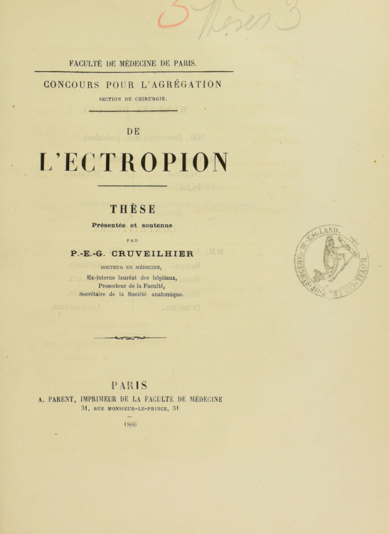 FACULTÉ UE MÉDECINE DE PARIS. f- CONCOURS POUR L’AGRÉGATION SECTION DE CHIRURGIE. DE f.’ECTROPION THÈSE Présentée et soutenue PA li P.-E.-G. CRUVEILHIER DOCTEUR EN MÉDECINE, Ex-interne lauréat des hôpitaux, Prosecteur de la Faculté, Secrétaire de la Société anatomique. P A R1 S A. PARENT, IMPRIMEUR DE LA FACULTÉ DE MÉDECINE 31. RUE MONSIEUR-LE-PRINCE, 31 1866