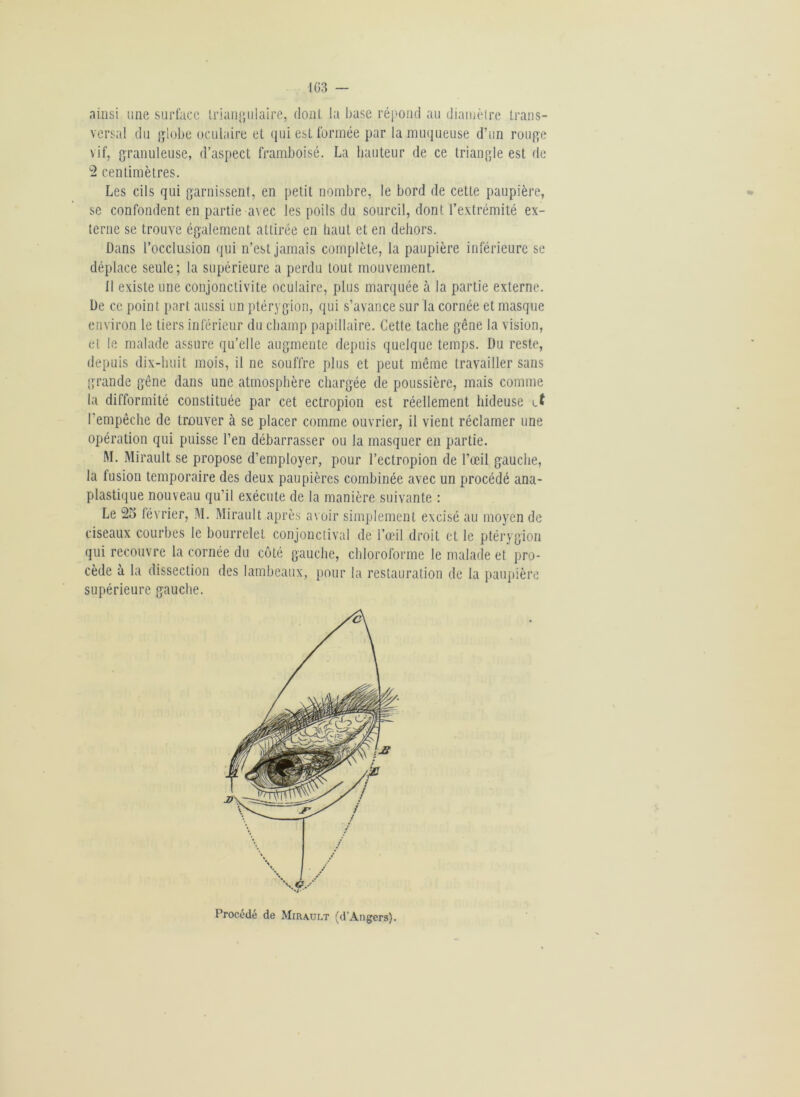 ainsi une surface triangulaire, dont la base répond au diamètre trans- versal du globe oculaire et qui est formée par la muqueuse d’un rouge vif, granuleuse, d’aspect framboisé. La hauteur de ce triangle est de 2 centimètres. Les cils qui garnissent, en petit nombre, le bord de cette paupière, se confondent en partie avec les poils du sourcil, dont l’extrémité ex- terne se trouve également attirée en haut et en dehors. Dans l’occlusion qui n’est jamais complète, la paupière inférieure se déplace seule; la supérieure a perdu tout mouvement. 11 existe une conjonctivite oculaire, plus marquée à la partie externe. De ce point part aussi un ptérygion, qui s’avance sur la cornée et masque environ le tiers inférieur du champ papillaire. Cette tache gêne la vision, et le malade assure qu’elle augmente depuis quelque temps. Du reste, depuis dix-huit mois, il ne souffre plus et peut même travailler sans grande gêne dans une atmosphère chargée de poussière, mais comme la difformité constituée par cet ectropion est réellement hideuse et l’empêche de trouver à se placer comme ouvrier, il vient réclamer une opération qui puisse l’en débarrasser ou la masquer en partie. M. Mirault se propose d’employer, pour l’ectropion de l’œil gauche, la fusion temporaire des deux paupières combinée avec un procédé ana- plastique nouveau qu’il exécute de la manière suivante : Le 25 février, M. Mirault après avoir simplement excisé au moyen de ciseaux courbes le bourrelet conjonctival de l’œil droit et le ptérygion qui recouvre la cornée du côté gauche, chloroforme le malade et pro- cède à la dissection des lambeaux, pour la restauration de la paupière supérieure gauche. Procédé de Mirault (d'Angers).