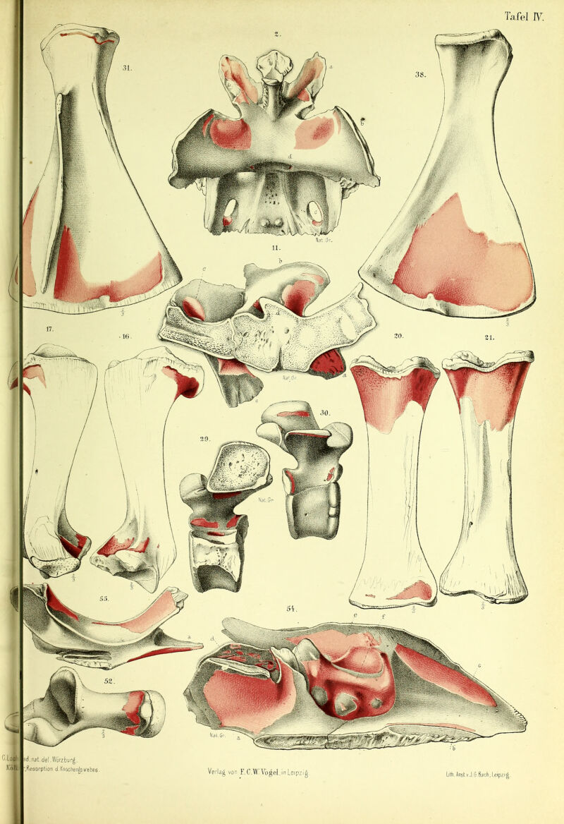 Tafel 17. Nat.Gf- Nat.Cr. C.LoÄti Jföll id.nat del.Würzbur^. '.Resorption d.Knoohen^swebos. Li tti.Anst.vJ,5-Bach, Leipzig.