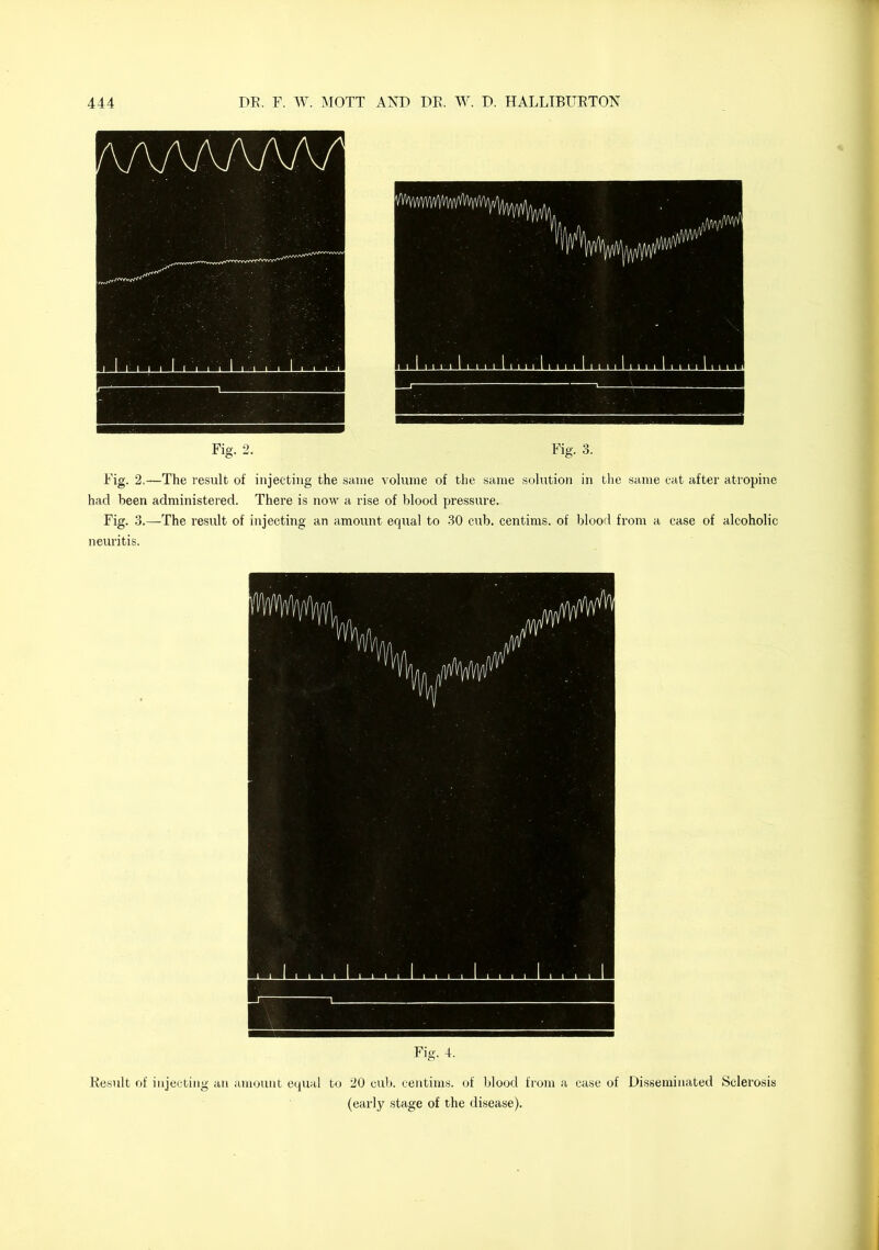 Fig. 2. Fig. 3. Fig. 2,—The result of injecting the same volume of the same solution in the same cat after atropine had been administered. There is now a rise of blood pressure. Fig. 3.—The result of injecting an amount equal to 30 cub. centims. of blood from a case of alcoholic neuritis. Fig. 4. Result of injecting an amount equal to 20 cub. centims. of blood from a case of Disseminated Sclerosis (early stage of the disease).