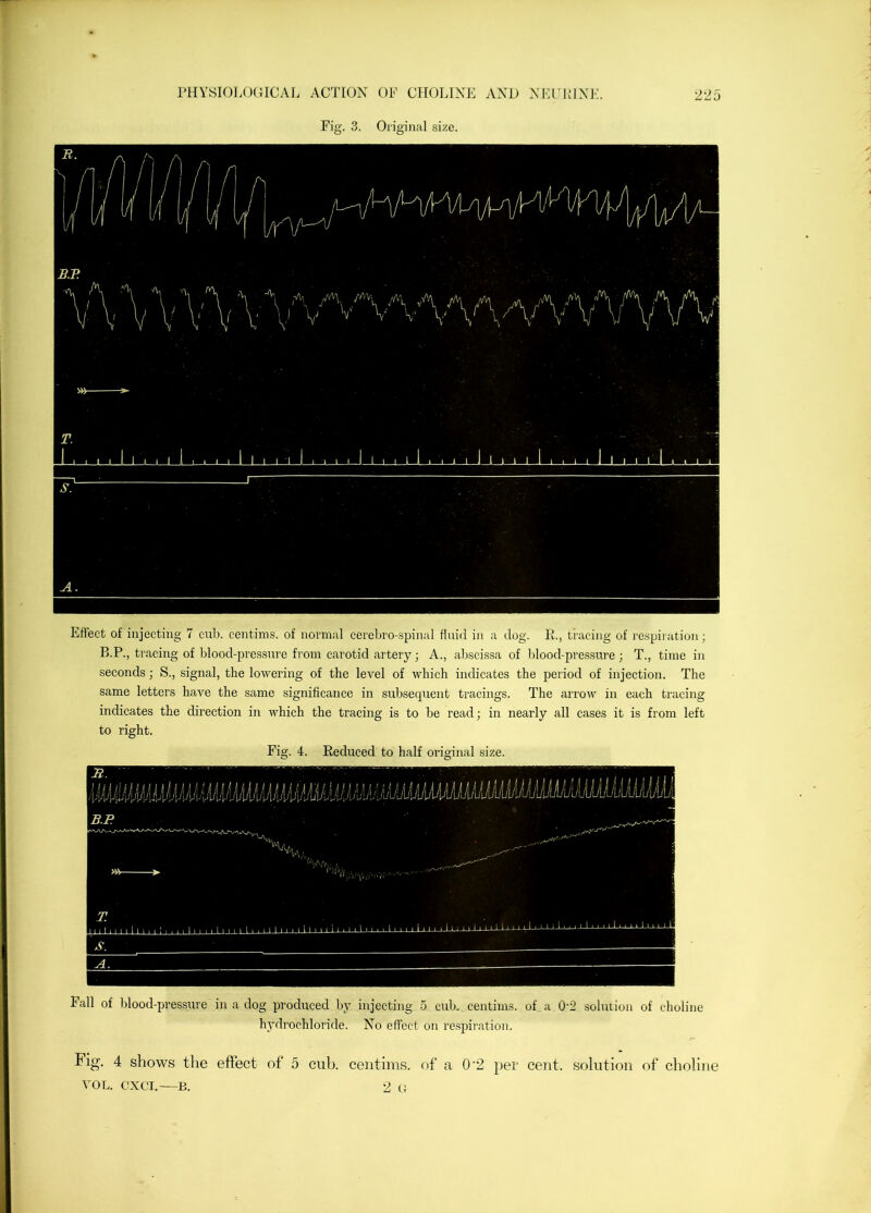 Fig. 3. Original size. Effect of injecting 7 cub. centims. of normal cerebro-spinal fluid in a dog. E., tracing of res^jiration; B.P., tracing of blood-pressure from carotid artery; A., absci.ssa of blood-pressure; T., time in seconds; S., signal, the lowering of the level of which indicates the period of injection. The same letters have the same significance in subsequent tracings. The arrow in each tracing indicates the direction in which the tracing is to be read; in nearly all cases it is from left to right. Fig. 4. Reduced to half original size. Fall of blood-pressure in a dog produced by injectiiig 5 cub. centims. of a 0'2 sohuion of choline hydrochloride. No effect on respiration. Fig. 4 shows the effect of 5 cub. centims. of a 0‘2 per cent, solution of choline VOL, CXCI.—B. 2 (f