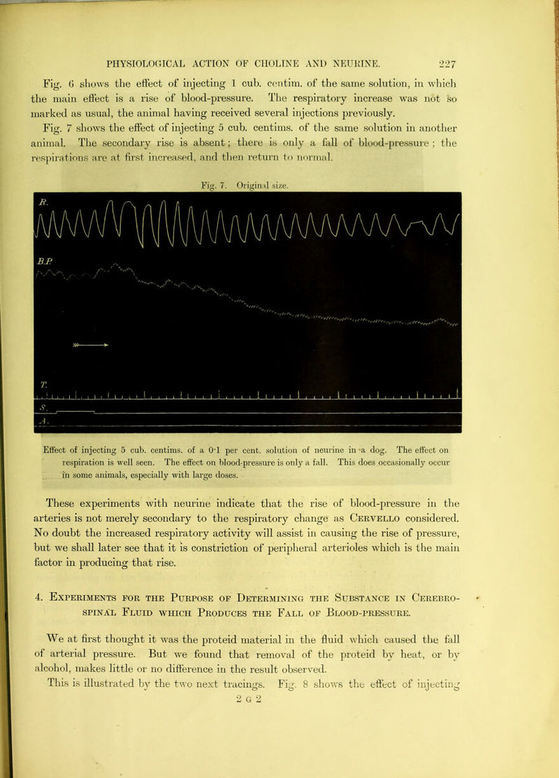 Fig. G shows the effect of injecting 1 cub. centira. of the same solution, in wliicli the main effect is a rise of blood-pressure. The respiratory increase was not so marked as usual, the animal having received several injections previously. Fig. 7 shows the effect of injecting 5 cub. centims. of the same solution in another animal. The secondary rise is absent; there is only a fall of blood-pre.ssure ; the respirations are at first inci’eased, and then return to normal. Fig. 7. Oiigin:il size. Effect of injecting 5 cub. centims. of a OT per cent, solution of neurine in -a clog. The effect on respiration is well seen. The effect on blood-pressure is only a fall. This does occasionally occur in some animals, especially with large doses. These experiments with neurine indicate that the rise of blood-pressure in the arteries is not merely secondary to the respiratory change as Cervello considered. No doubt the increased respiratory activity will assist in causing the rise of pressure, but we shall later see that it is constriction of peripheral arterioles which is the main factor in producing that rise. 4. Experiments for the Purpose of Determining the Substance in Cerebro- spinal Fluid which Produces the Fall of Blood-pressure. We at first thought it was the proteid material in the fluid which caused the fall of arterial pressure. But we found that removal of the proteid by heat, or bv alcohol, makes little or no difference in the result observed. This is illustrated by the two next tracings. Fig. 8 shows the effect of injecting