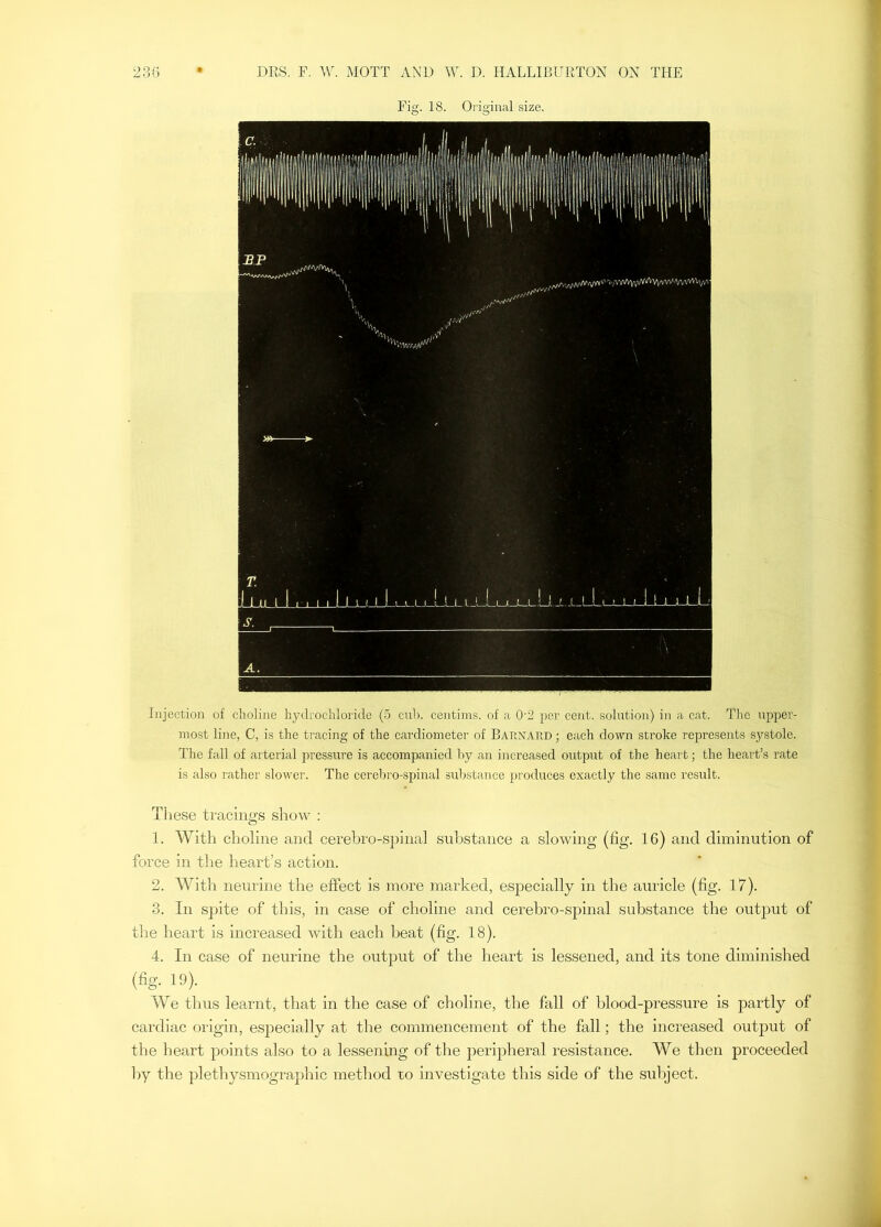 1 Fig. 18. Oi’igiiial size. Injection of choline hydrochloride (5 cub. eentims. of a 0'2 per cent, solution) in a cat. The upper- most line, C, is the tracing of the cardiometer of Barnard ; each down stroke represents systole. The fall of arterial pressure is accompanied by an increased output of the heart; the heart’s rate is also rather slower. The cerebro-spinal substance produces exactly the same result. Tliese tracings show : 1. With choline and cerebro-spinal substance a slowing (fig. 16) and diminution of force in the heart’s action. 2. With neurine the effect is more marked, especially in the auricle (fig. 17). 3. In sjjite of this, in case of choline and cerebro-spinal substance the output of the heart is increased with each beat (fig. 18). 4. In case of neurine the output of the heart is lessened, and its tone diminished (fig. 19). We thus learnt, that in the case of choline, the fall of blood-pressure is partly of cardiac origin, especially at the commencement of the fall; the increased output of the heart points also to a lessening of the peripheral resistance. We then proceeded by the plethysmographic method ro investigate this side of the subject. -M