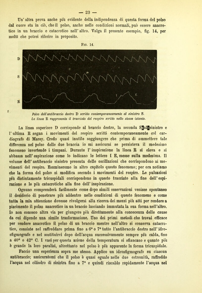 Un’ altra prova anche piu evidente della indipendenza di questa forma del polso dal cuore sta in ciò, che il polso, anche nelle condizioni normali, può essere anacro- tico in un braccio e catacrotico nell’ altro. Valga il presente esempio, fig. 14, per molti che potrei riferire in proposito. Fig. 14. D S R Polso dell’antibraccio destro D scritto contemporaneamente al sinistro S. La linea R rappresenta il tracciato del respiro scritto nello stesso istante. La linea superiore D corrisponde al braccio destro, la seconda S2algsinistro e l’ultima R segna i movimenti del respiro scritti contemporaneamente col car- diografo di Marey. Credo quasi inutile soggiungere che prima di ammettere tale differenza nel polso delle due braccia io mi assicurai se persisteva il medesimo fenomeno invertendo i timpani. Durante l’inspirazione la linea R si eleva e si abbassa nell’ espirazione come lo indicano le lettere I E, messe sulla medesima. Il volume dell’ antibraccio sinistro presenta delle oscillazioni che corrispondono ai mo- vimenti del respiro. Esamineremo in altro capitolo questo fenomeno; per ora notiamo che la forma del polso si modifica secondo i movimenti del respiro. Le pulsazioni più distintamente tricuspidali corrispondono in questo tracciato alla fine dell’espi- razione e le più catacrotiche alla fine dell’ inspirazione. Ognuno comprenderà facilmente come dopo simili osservazioni venisse spontaneo il desiderio di penetrare più addentro nelle condizioni di questo fenomeno e come tutta la mia attenzione dovesse rivolgersi alla ricerca dei mezzi più atti per rendere a piacimento il polso anacrotico in un braccio lasciando immutata la sua forma nell’altro. Io non conosco altra via per giungere più direttamente alla conoscenza delle cause da cui dipende una simile trasformazione. Uno dei primi metodi che trovai efficace per rendere anacrotico il polso di un braccio mentre nell’altro si conserva catacro- tico, consiste nel raffreddare prima fino a 6° o 7° tutto l’antibraccio destro nell’ idro- sfigmografo e nel sostituirvi dopo dell'acqua successivamente sempre più calda, fino a 40° o 42° C. I vasi per questa azione della temperatura si sfiancano e quanto più ò grande la loro paralisi, altrettanto nel polso è più apparente la forma tricuspidale. Faccio una esperienza sopra me stesso. Applico un idrosfigmografo su ciascun antibraccio; assicuratomi che il polso è quasi eguale nelle due estremità, raffreddo l’acqua nel cilindro di sinistra fino a 7° e quindi riscaldo rapidamente l’acqua nel