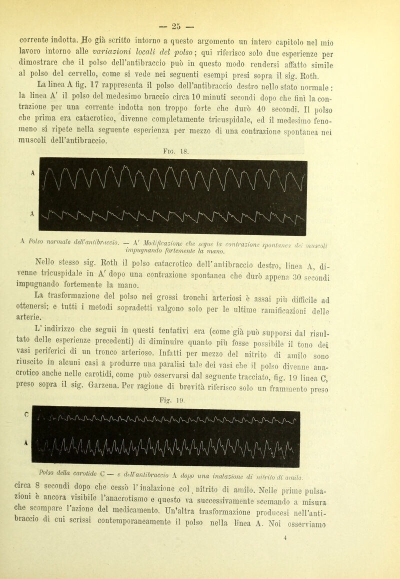 corrente indotta. Ho già scritto intorno a questo argomento un intero capitolo nel mio lavoro intorno alle veti ictzioni locali del polso 5 qui riferisco solo due esperienze per dimostrare che il polso dell’antibraccio può in questo modo rendersi affatto simile al polso del cervello, come si vede nei seguenti esempi presi sopra il sig. Rotli. LalineaAfig. 17 rappresenta il polso dell’antibraccio destro nello stato normale: la linea A' il polso del medesimo braccio circa 10 minuti secondi dopo che finì la con- trazione per una corrente indotta non troppo forte che durò 40 secondi. Il polso che prima era catacrotico, divenne completamente tricuspidale, ed il medesimo feno- meno si ripete nella seguente esperienza per mezzo di una contrazione spontanea nei muscoli dell’antibraccio. Fio. 18. A Polso normale dell antibraccio. — A' Modificazione che segue la contrazione spontane i dei muscoli impugnando fortemente la mano. hello stesso sig. Roth il polso catacrotico dell’antibraccio destro, linea A, di- venne tricuspidale in A' dopo una contrazione spontanea che durò appena 30 secondi impugnando fortemente la mano. La trasformazione del polso nei grossi tronchi arteriosi è assai più difficile ad ottenersi; e tutti i metodi sopradetti valgono solo per le ultime ramificazioni delle arterie. L indirizzo che seguii in questi tentativi era (come già può supporsi dal risul- tato delle esperienze precedenti) di diminuire quanto più fosse possibile il tono dei vasi periferici di un tronco arterioso. Infatti per mezzo del nitrito di amilo sono riuscito in alcuni casi a produrre una paralisi tale dei vasi che il polso divenne ana- crotico anche nelle carotidi, come può osservarsi dal seguente tracciato, fig. 19 linea C, preso sopra il sig. Garzena. Per ragione di brevità riferisco solo un frammento preso Fig1. 19. Polso della carotide C — e dell'antibraccio A dopo una inalazione di nitrito di amilo. circa 8 secondi dopo che cessò l’inalazione col. nitrito di amilo. Nelle prime pulsa- zioni e ancora visibile l’anacrotismo e questo va successivamente scemando a misura che scompare l’azione del medicamento. Un’altra trasformazione produce» nell’anti- braccio di cui scrissi contemporaneamente il polso nella linea A. Noi osserviamo 4
