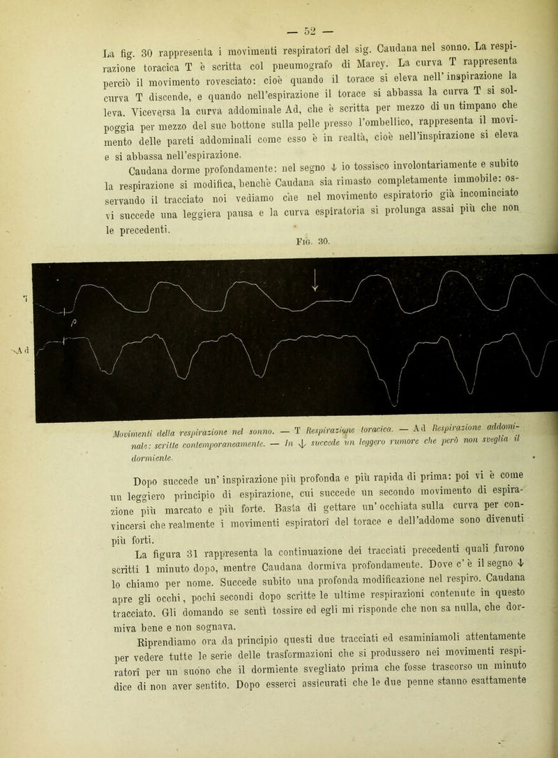 La fig. 30 rappresenta i movimenti respiratovi del sig. Caudaua nel sonno. La ìespi- razione toracica T è scritta col pneumografo di Marey. La curva T rappresenta perciò il movimento rovesciato: cioè quando il torace si eleva nell’inspirazione a curva T discende, e quando nell’espirazione il torace si abbassa la curva T si sol- leva. Viceversa la curva addominale Ad, che è scritta per mezzo di un timpano che poggia per mezzo del suo bottone sulla pelle presso l’ombellico, rappresenta il movi- mento delle pareti addominali come esso è in realtà, cioè nell’inspirazione si eleva e si abbassa nell’espirazione. Caudana dorme profondamente: nel segno l io tossisco involontariamente e subito la respirazione si modifica, benché Caudana sia rimasto completamente immobile: os- servando il tracciato noi vediamo che nel movimento espiratorio già incominciato vi succede una leggiera pausa e la curva espiratoria si prolunga assai piu che non dormiente. Dopo succede un’ inspirazione più profonda e più rapida di prima: poi vi è come un leggiero principio di espirazione, cui succede un secondo movimento di espira- zione più marcato e più forte. Basta di gettare un’ occhiata sulla curva per con- vincersi che realmente i movimenti espiratori del torace e dell’addome sono divenuti più forti. _ _ La figura 31 rappresenta la continuazione dei tracciati precedenti quali furono scritti 1 minuto dopo, mentre Caudana dormiva profondamente. Dove c’ è il segno L lo chiamo per nome. Succede subito una profonda modificazione nel respiro. Caudana apre gli occhi, pochi secondi dopo scritte le ultime respirazioni contenute in questo tracciato. Gli domando se sentì tossire ed egli mi risponde che non sa nulla, che dor- miva bene e non sognava. Riprendiamo ora .da principio questi due tracciati ed esaminiamoli attentamente per vedere tutte le serie delle trasformazioni che si produssero nei movimenti respi- ratori per un suono che il dormiente svegliato prima che fosse trascorso un minuto dice di non aver sentito. Dopo esserci assicurati che le due penne stanno esattamente