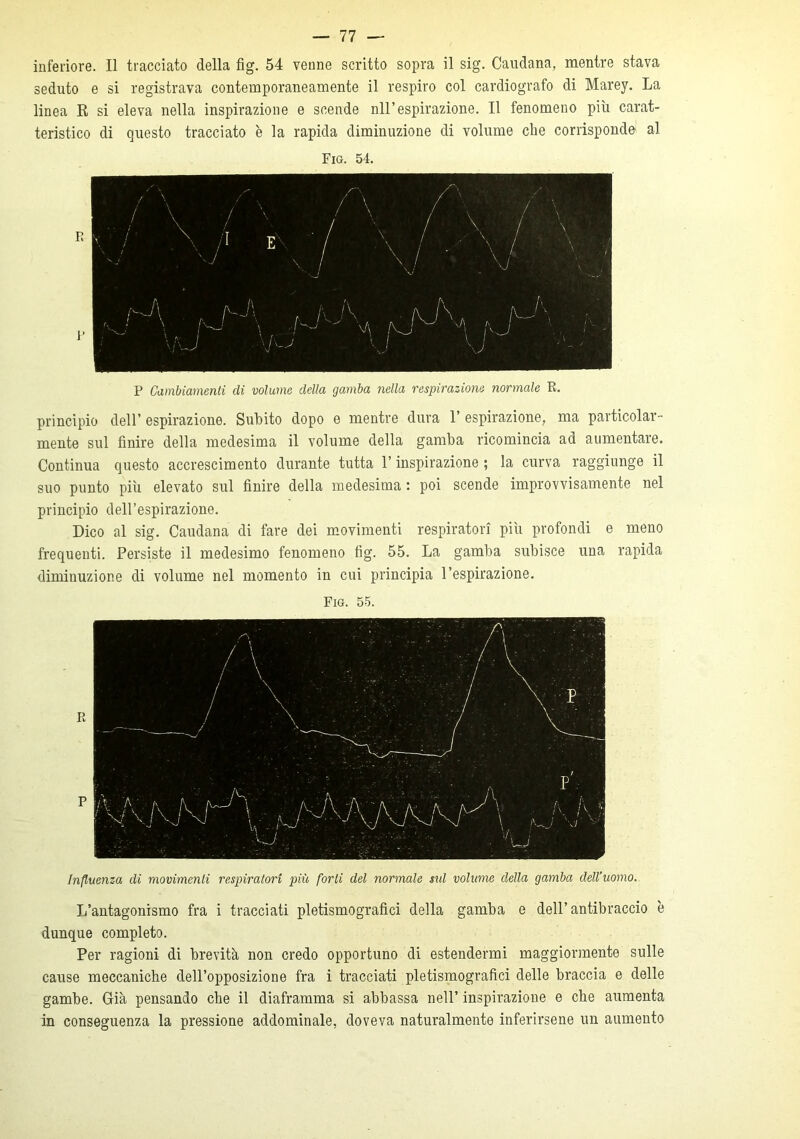 inferiore. Il tracciato della fig. 54 venne scritto sopra il sig. Caudana, mentre stava seduto e si registrava contemporaneamente il respiro col cardiografo di Marey. La linea R si eleva nella inspirazione e scende nll’espirazione. Il fenomeno più carat- teristico di questo tracciato è la rapida diminuzione di volume che corrisponde al P Cambiamenti di volume della gamba nella respirazione normale R. principio dell’ espirazione. Subito dopo e mentre dura 1’ espirazione, ma particolar- mente sul finire della medesima il volume della gamba ricomincia ad aumentare. Continua questo accrescimento durante tutta l’inspirazione ; la curva raggiunge il suo punto più elevato sul finire della medesima : poi scende improvvisamente nel principio dell’espirazione. Dico al sig. Caudana di fare dei movimenti respiratori più profondi e meno frequenti. Persiste il medesimo fenomeno fig. 55. La gamba subisce una rapida diminuzione di volume nel momento in cui principia l’espirazione. Fio. 55. Influenza di movimenti respiratori più forti del normale sul volume della gamba dell’uomo. L’antagonismo fra i tracciati pietismografici della gamba e dell’antibraccio è dunque completo. Per ragioni di brevità non credo opportuno di estendermi maggiormente sulle cause meccaniche dell’opposizione fra i tracciati pietismografici delle braccia e delle gambe. Già pensando che il diaframma si abbassa nell’ inspirazione e che aumenta in conseguenza la pressione addominale, doveva naturalmente inferirsene un aumento